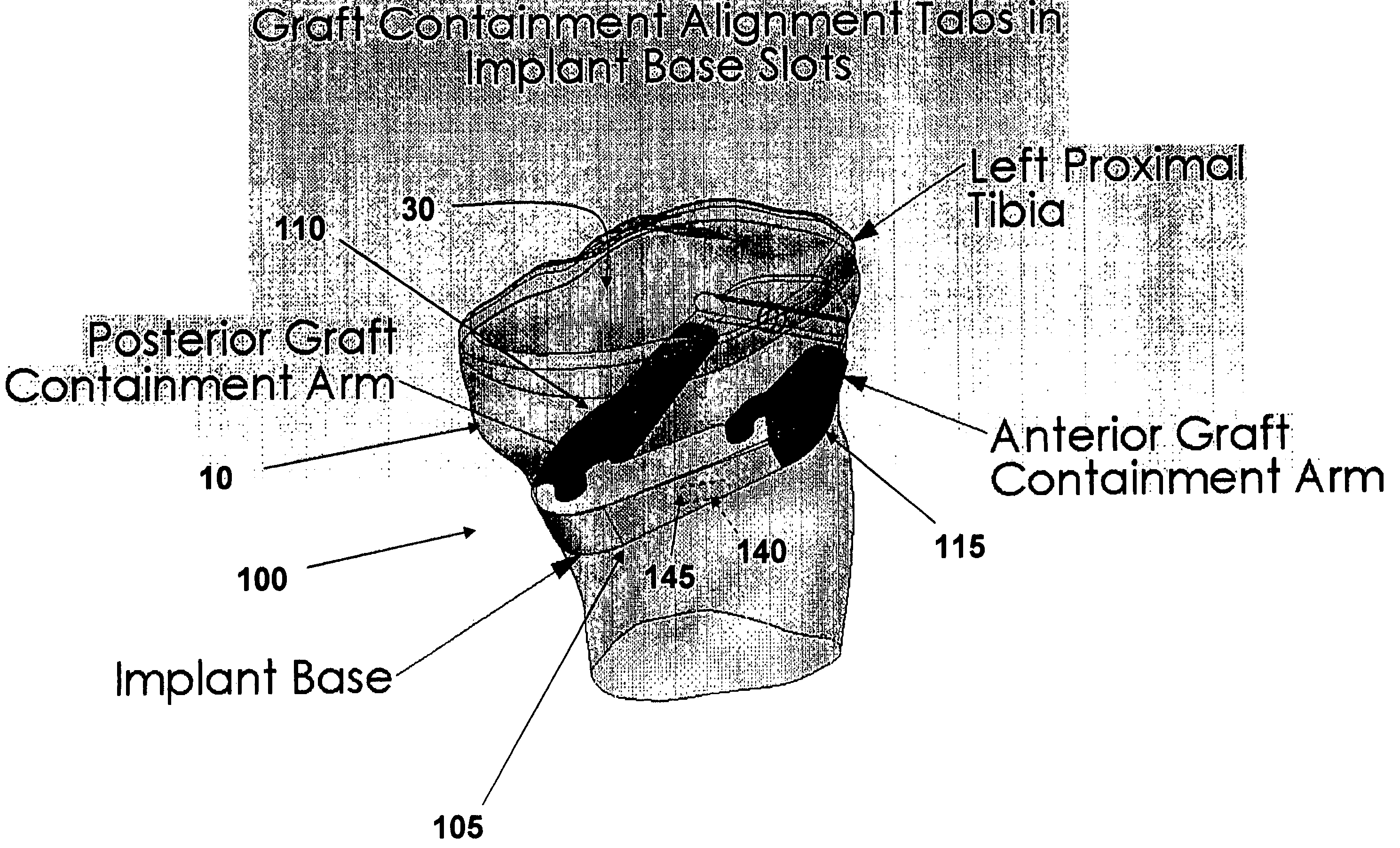 Multi-part implant for open wedge knee osteotomies