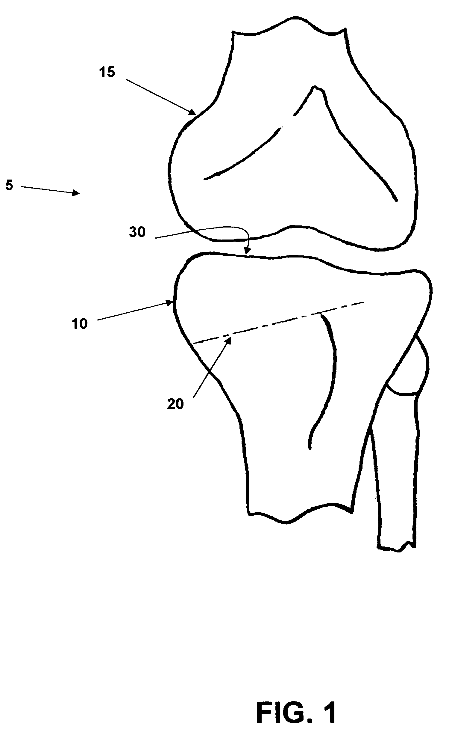 Multi-part implant for open wedge knee osteotomies