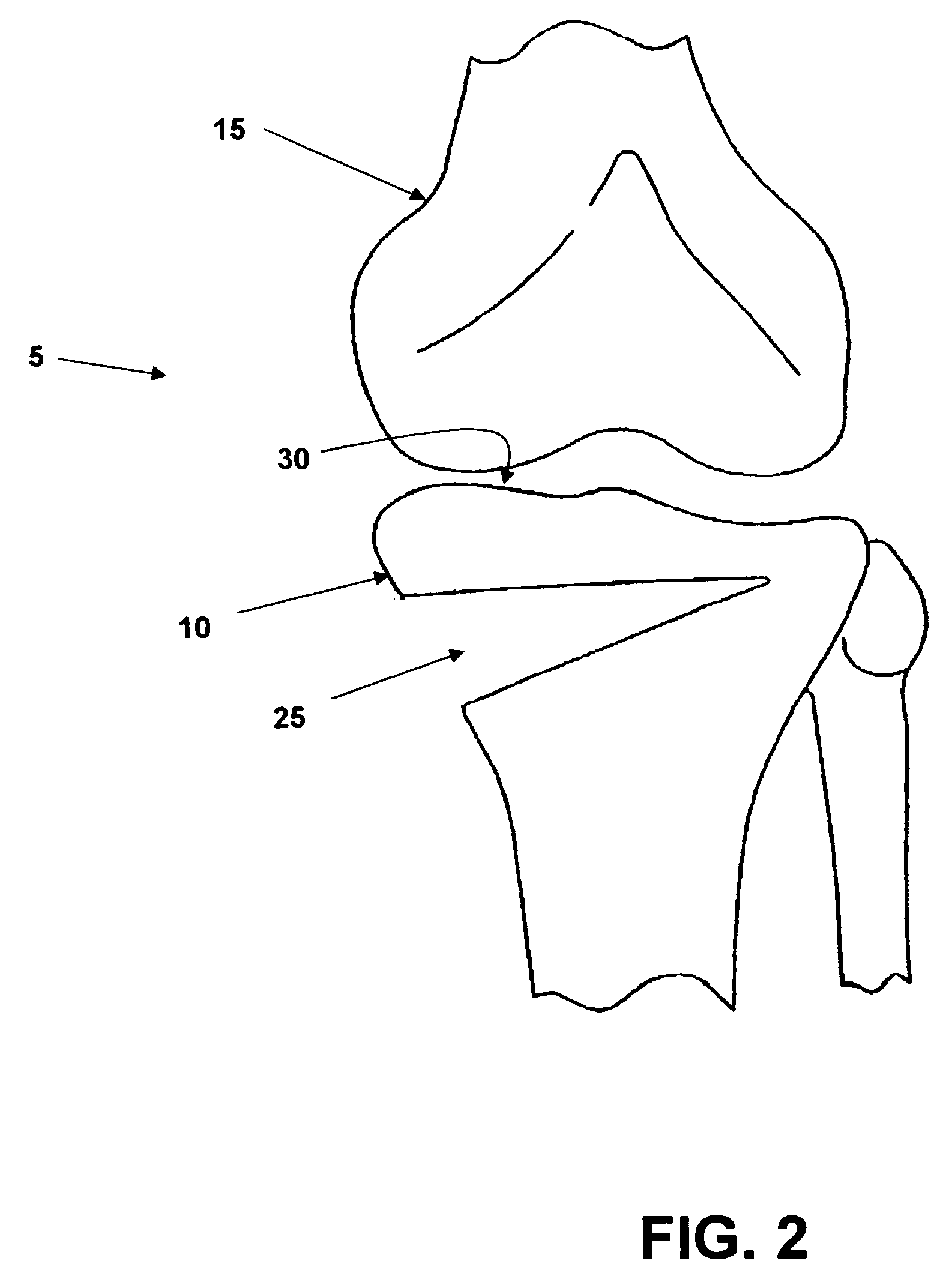 Multi-part implant for open wedge knee osteotomies