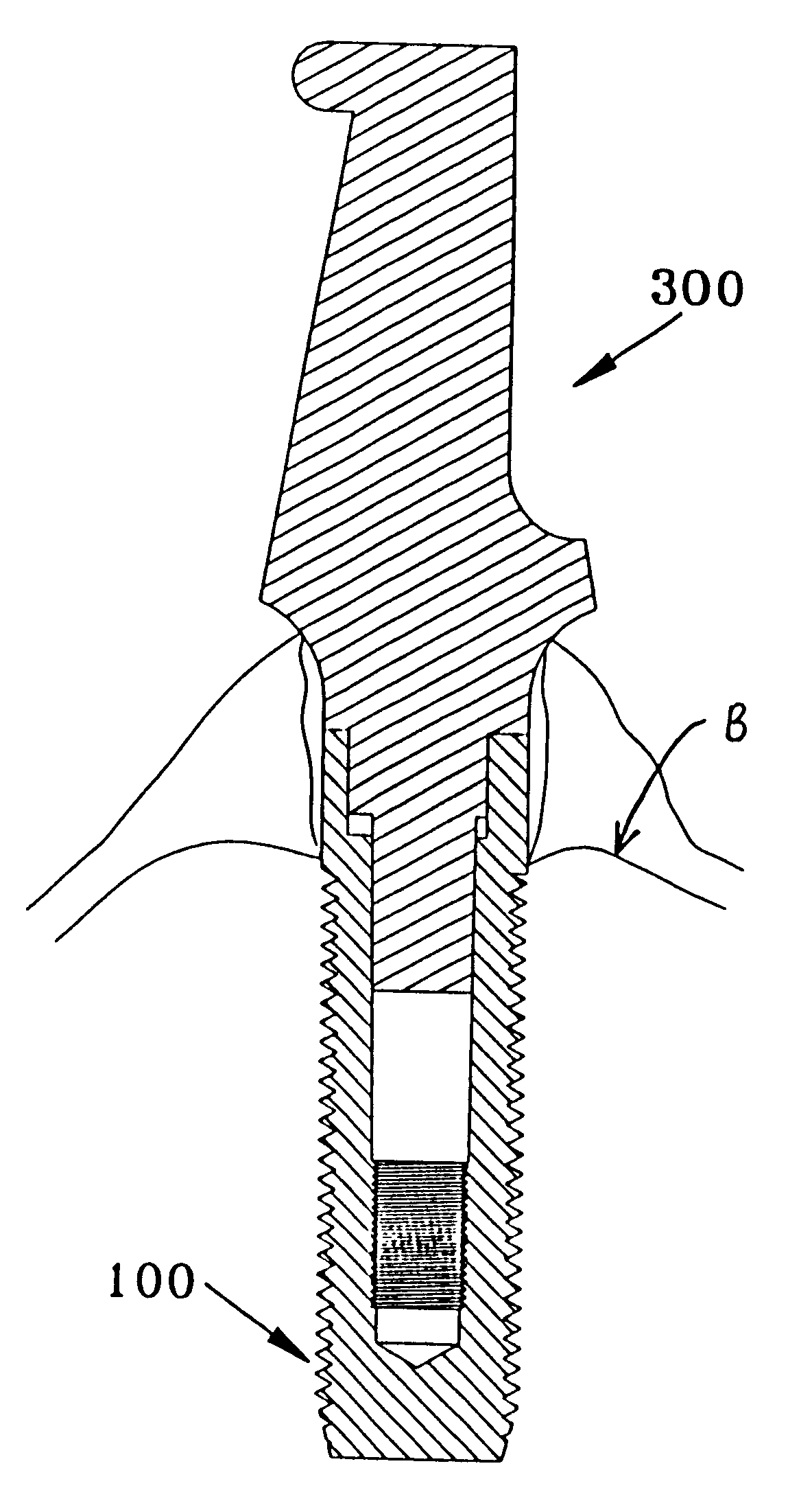 Dental implant system and method for effecting a dental restoration using the same