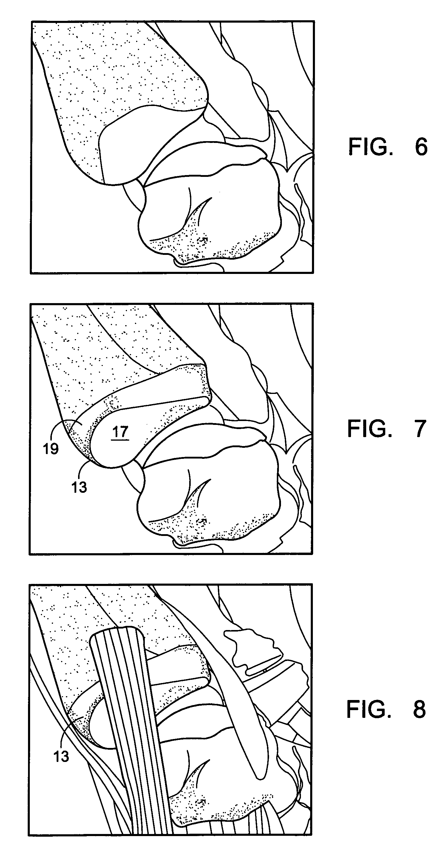 Carpometacarpal joint prosthesis