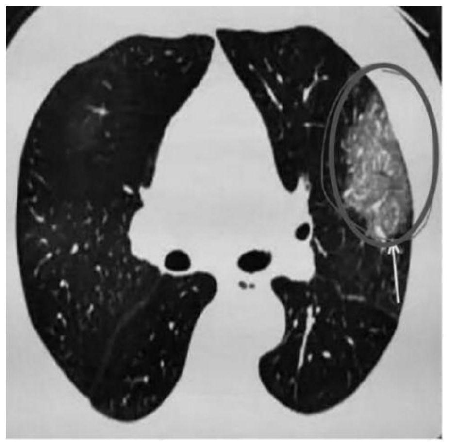 CT image denoising method based on wavelet transformation