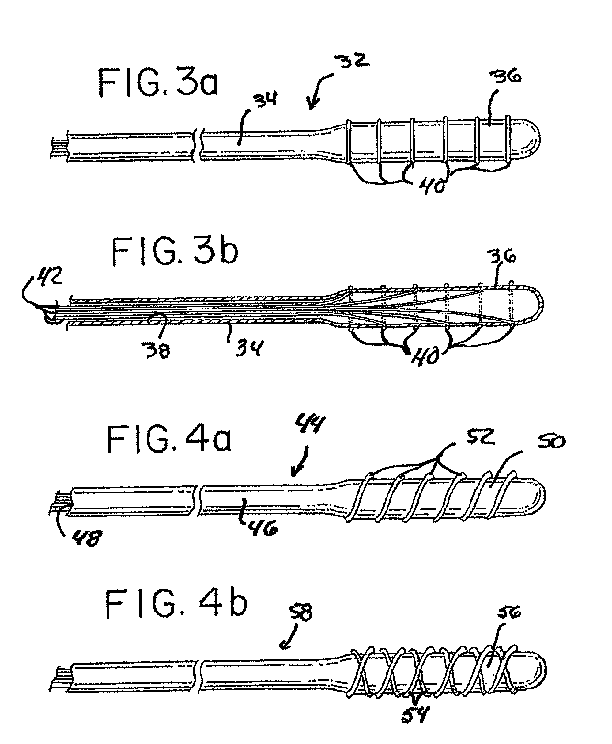 Method and apparatus for remodeling/profiling a tissue lumen, particularly in the urethral lumen in the prostate gland