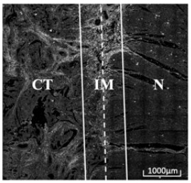 A colorectal cancer collagen evaluation and prognosis prediction device and storage medium