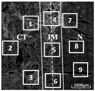 A colorectal cancer collagen evaluation and prognosis prediction device and storage medium