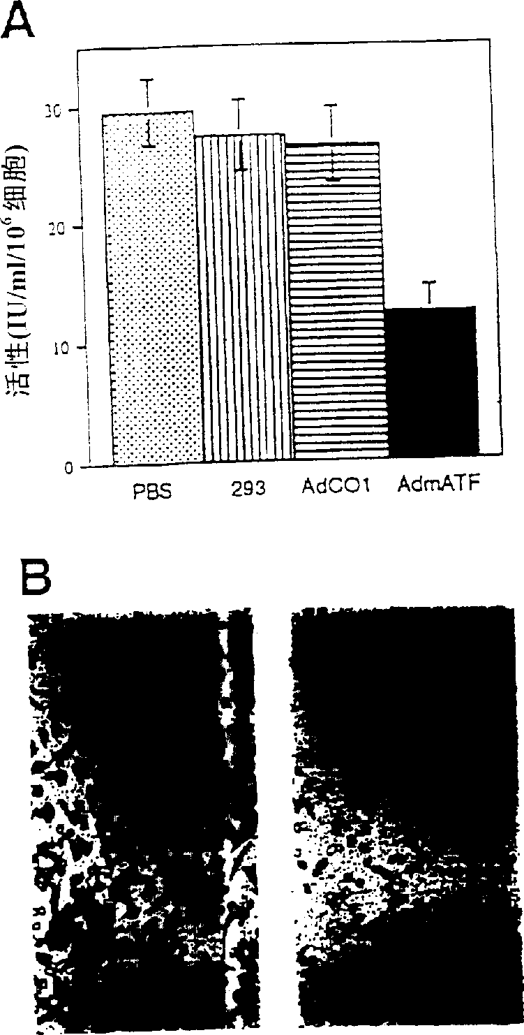 Adneovirus-mediated intratumoral delivery of angiogenesis antagonist for treatment of tumors