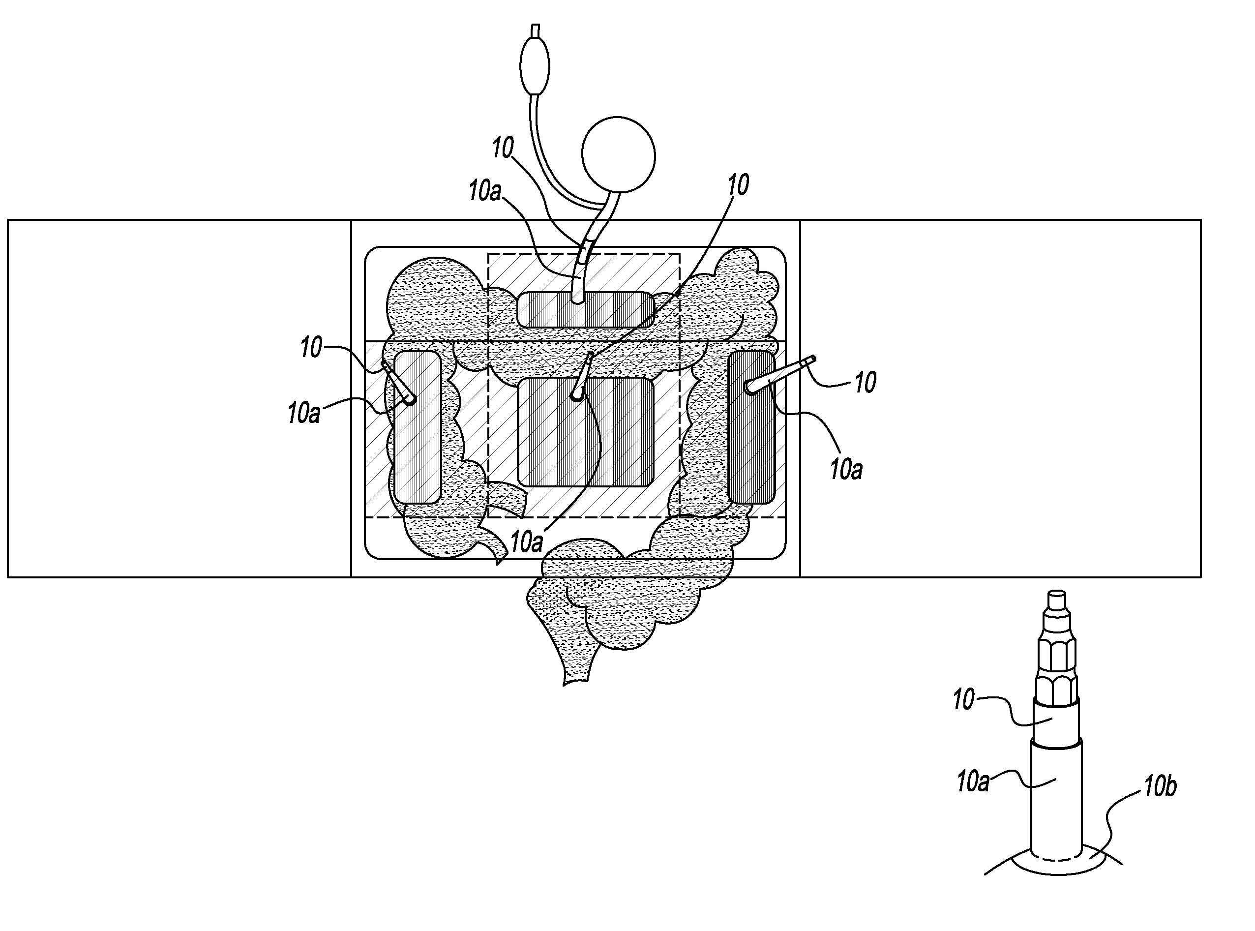 External Pneumatic Compression Device