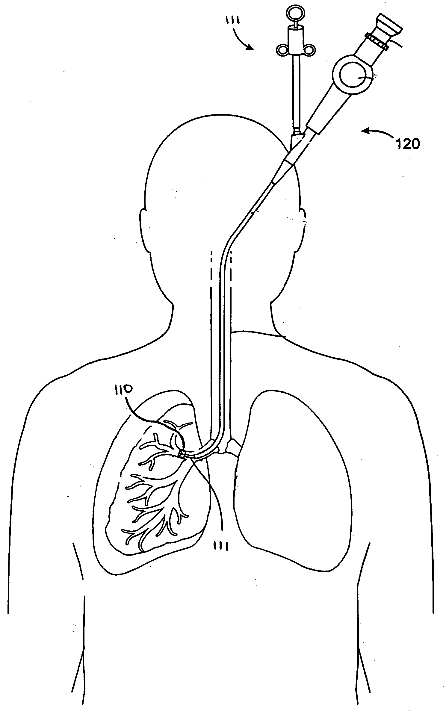 Treatment planning with implantable bronchial isolation devices