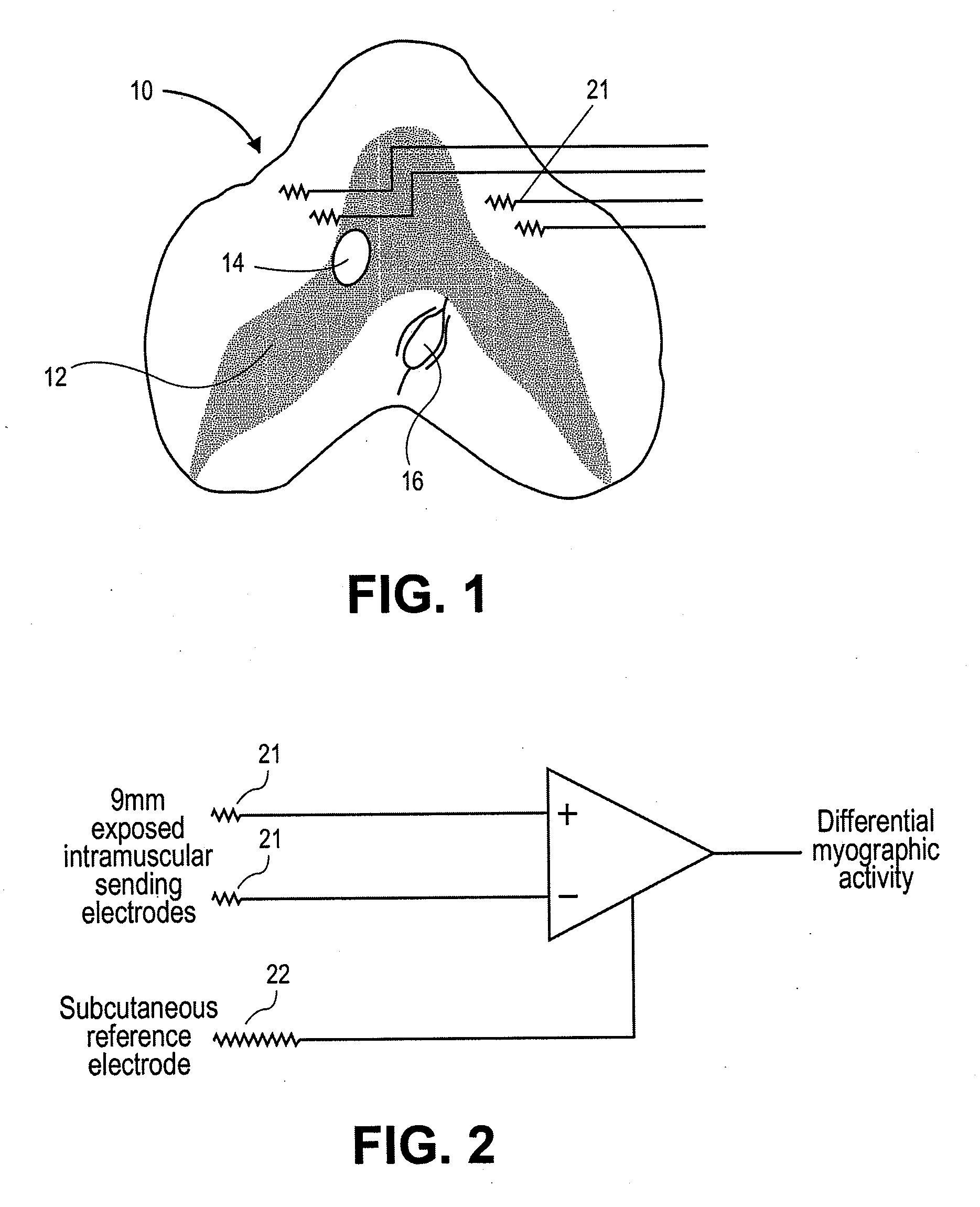 Devices and methods for assessing motor point electromyogram as a biomarker