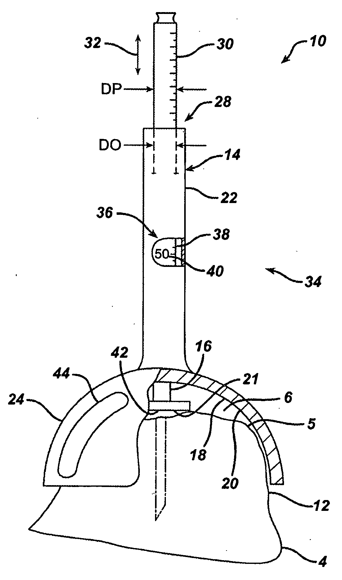 Joint Arthroplasty Kit and Method