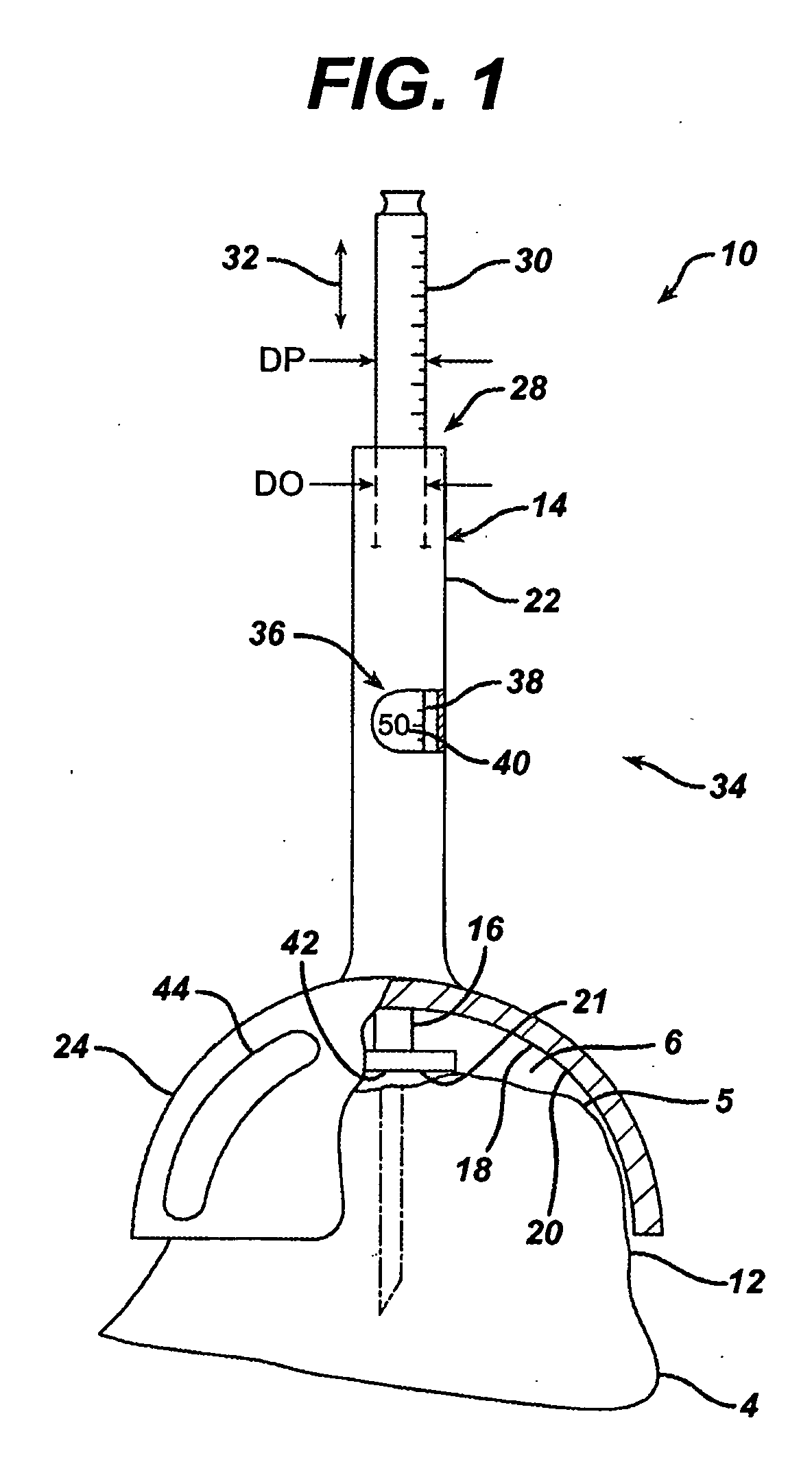 Joint Arthroplasty Kit and Method