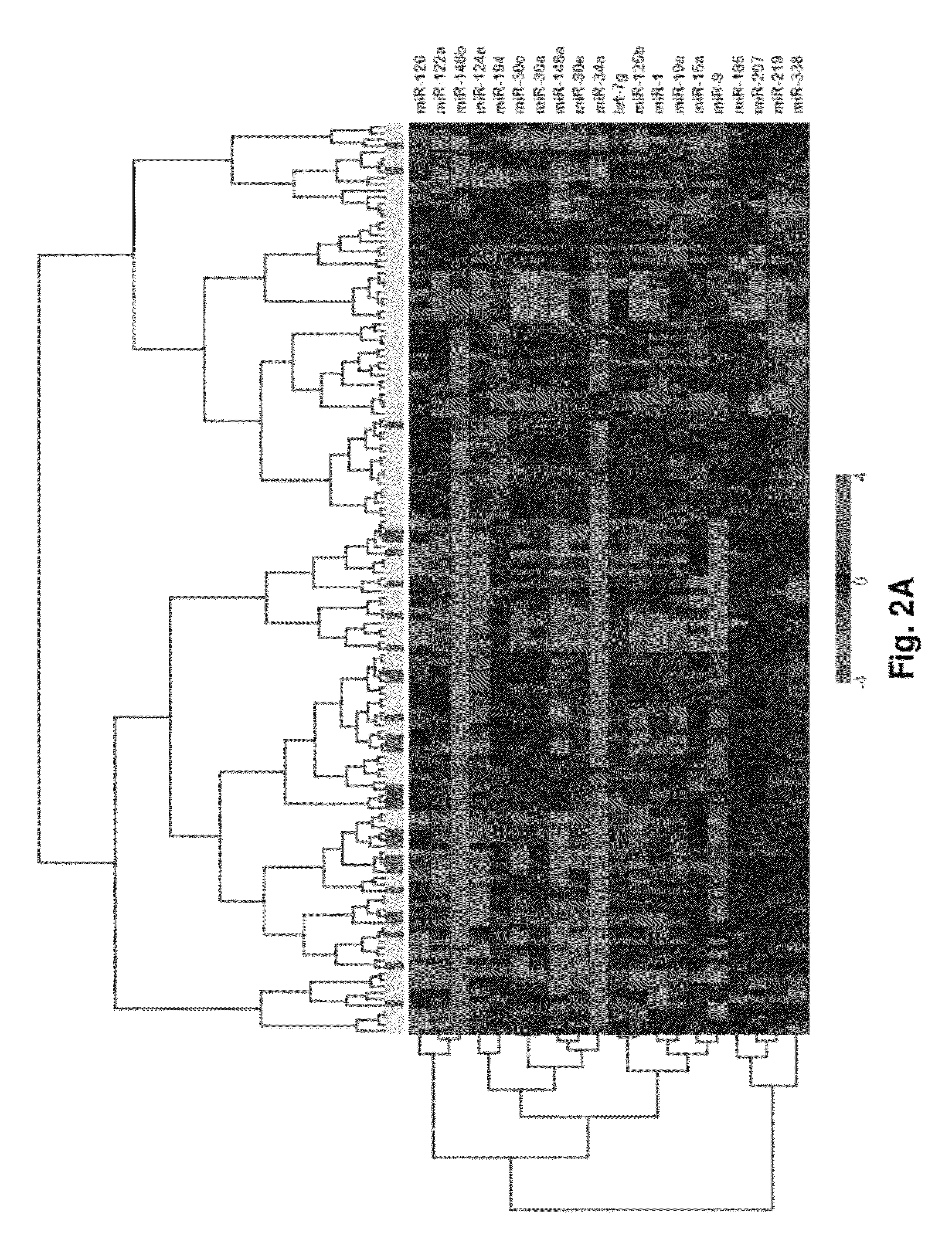 MicroRNA expression signature for predicting survival and metastases in hepatocellular carcinoma