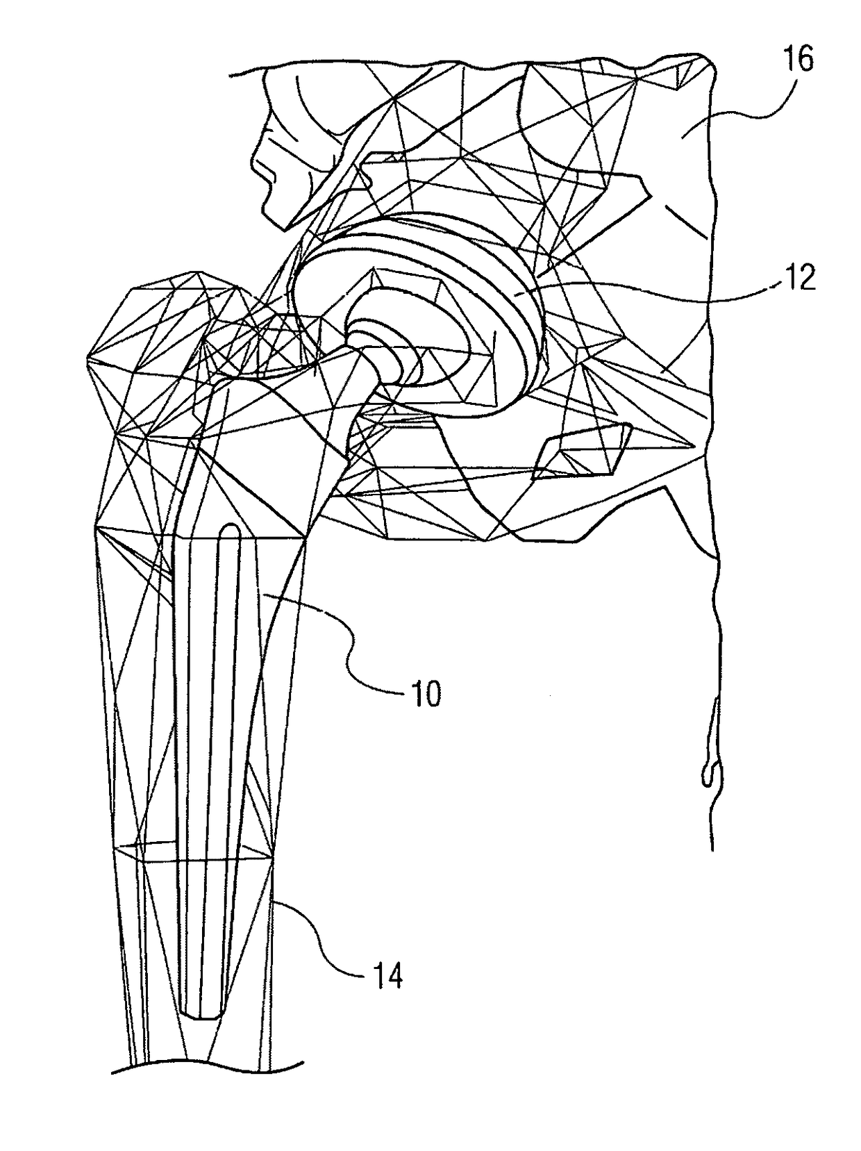 Patient specific implantation method for range of motion hip impingement