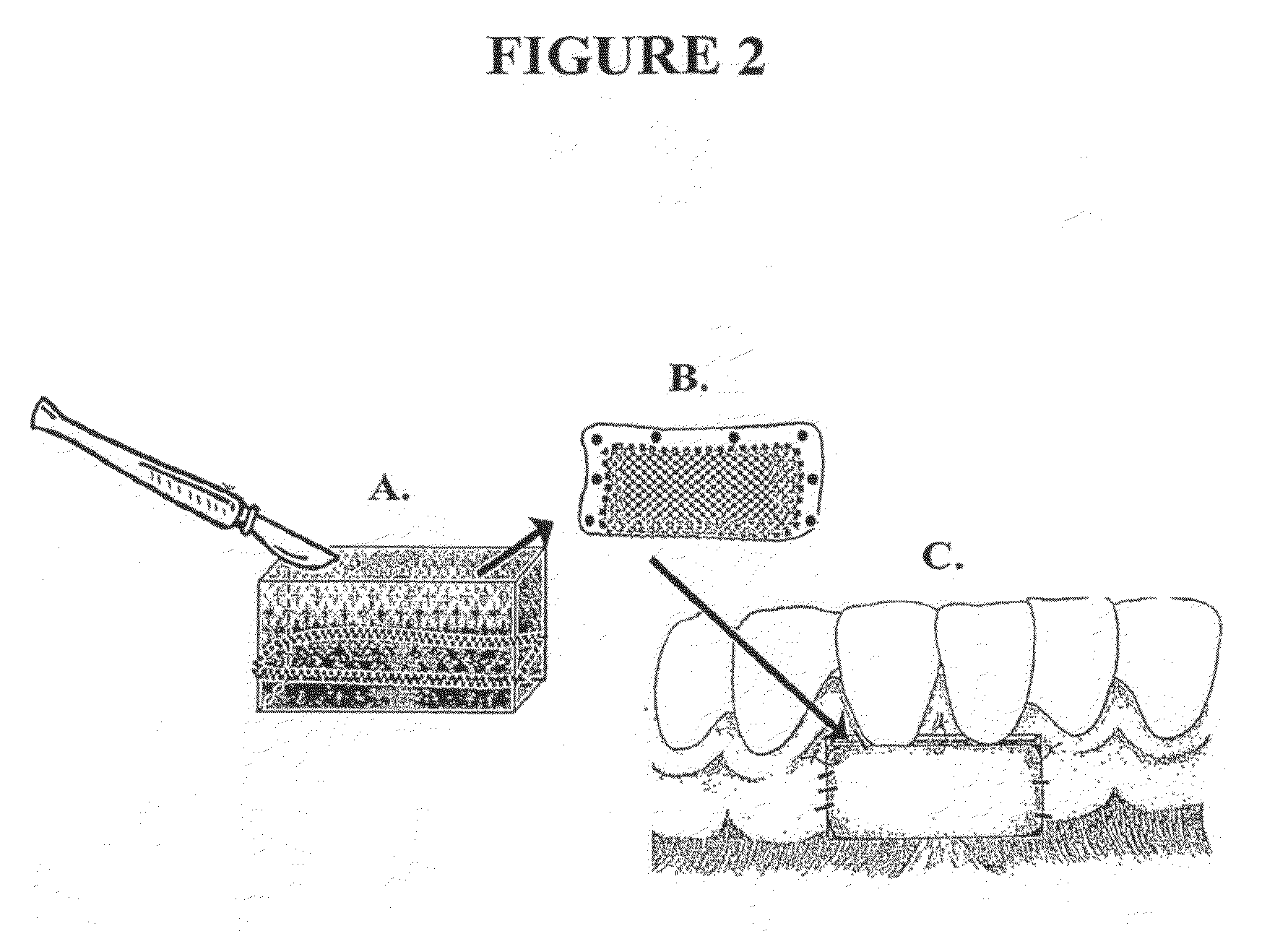 Autologous Oral Grafts