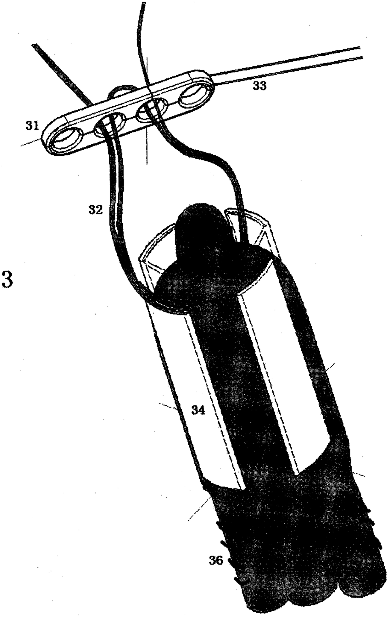 Ligament fixation system comprising suspensory steel plate and absorbable implant