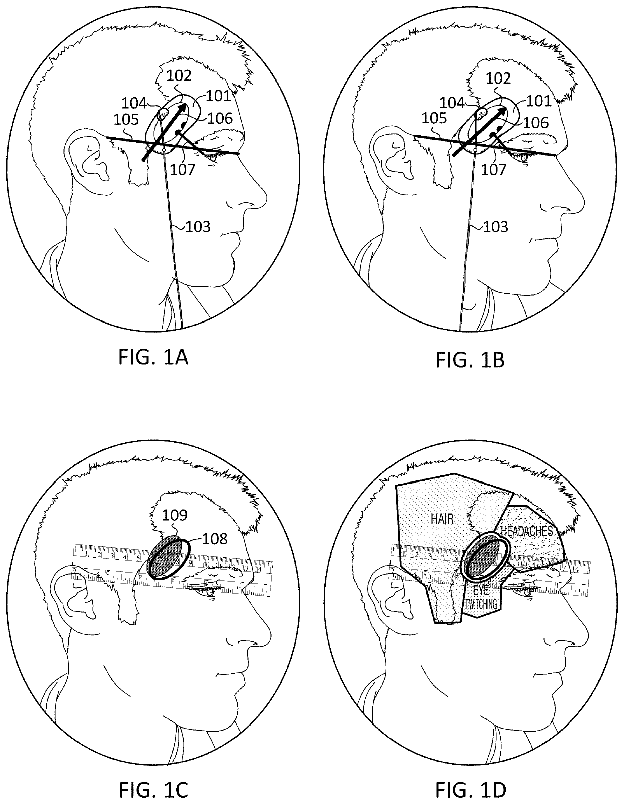 Apparatuses and methods for transdermal electrical stimulation of nerves to modify or induce a cognitive state