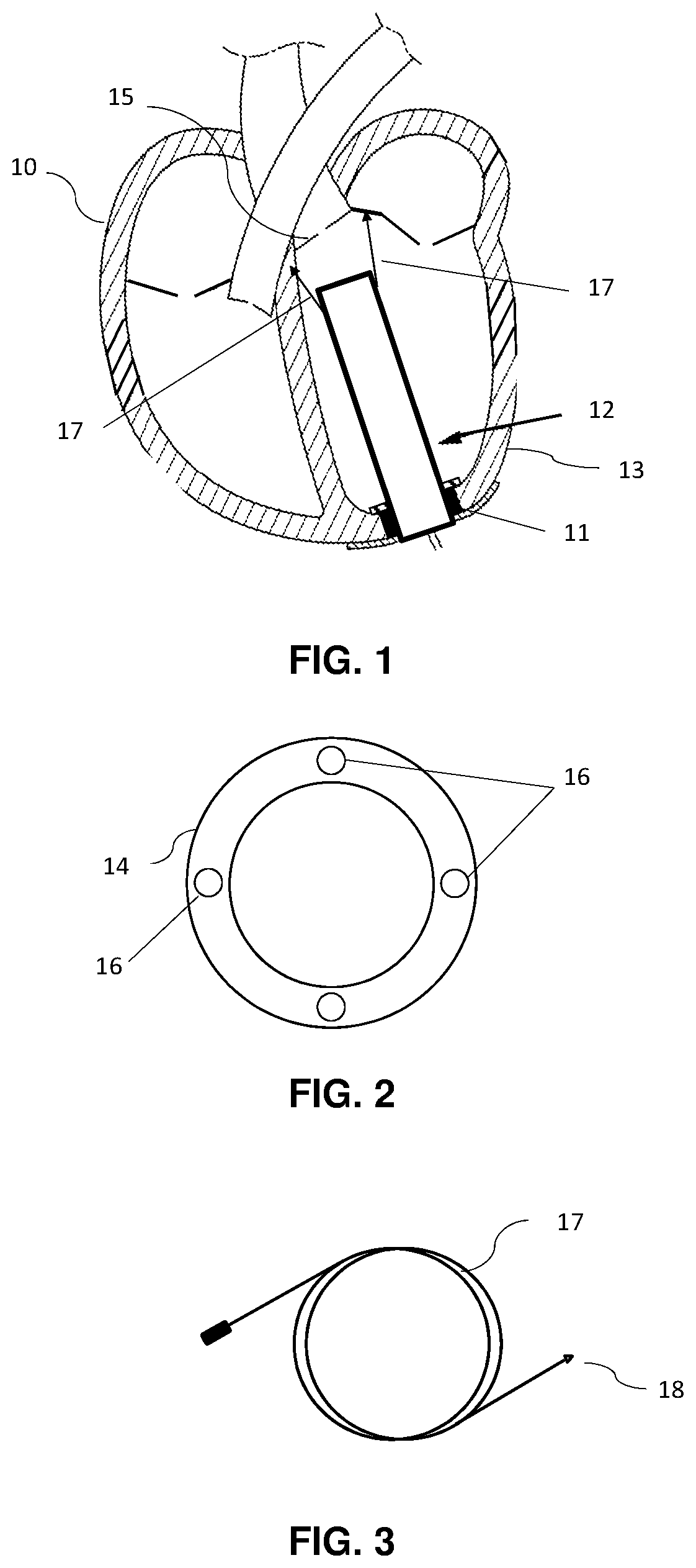 Ventricular assistance assembly with stabilized cardiac pump