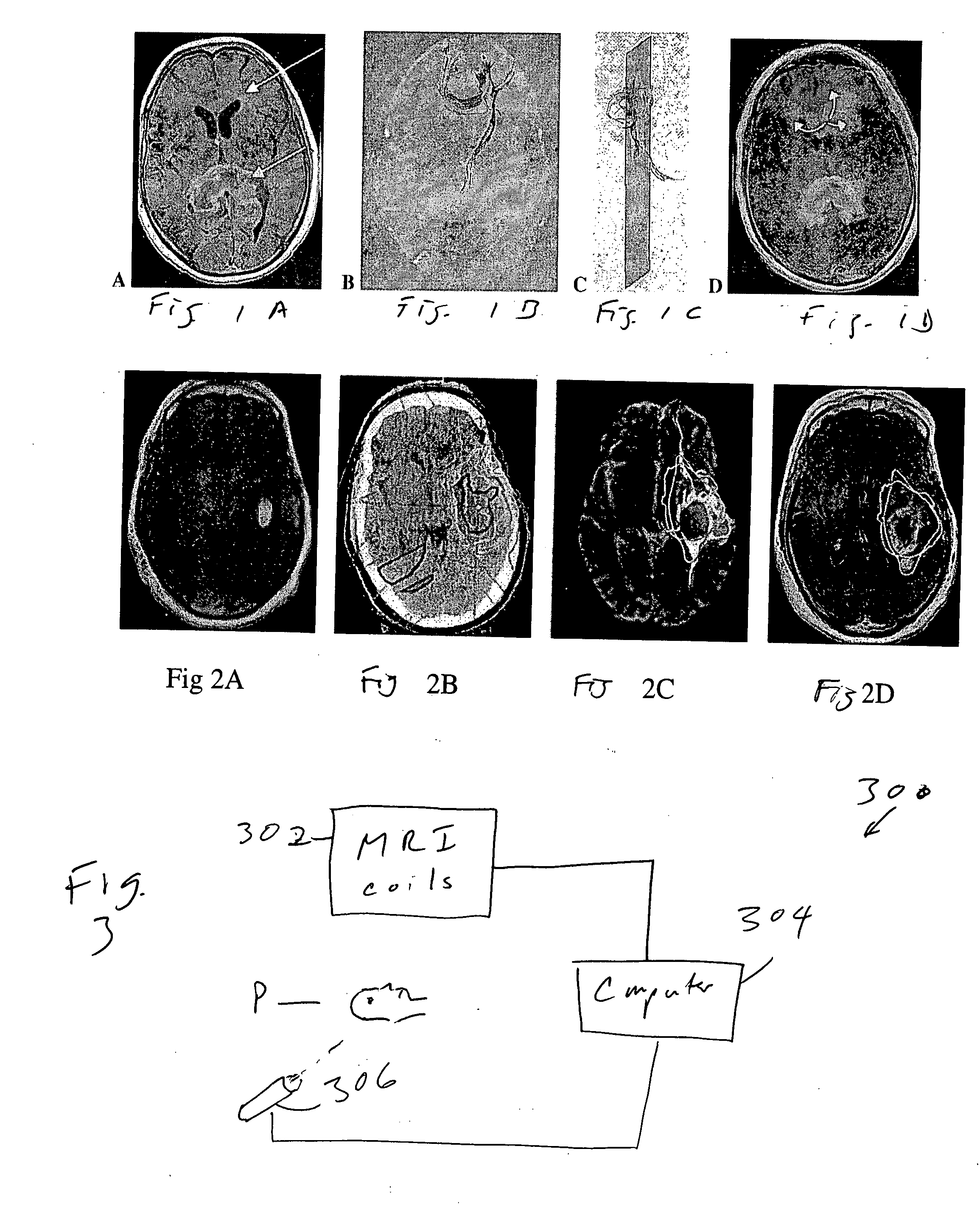 Prediction and treatment of brain tumor spread using MRI and external beam radiation