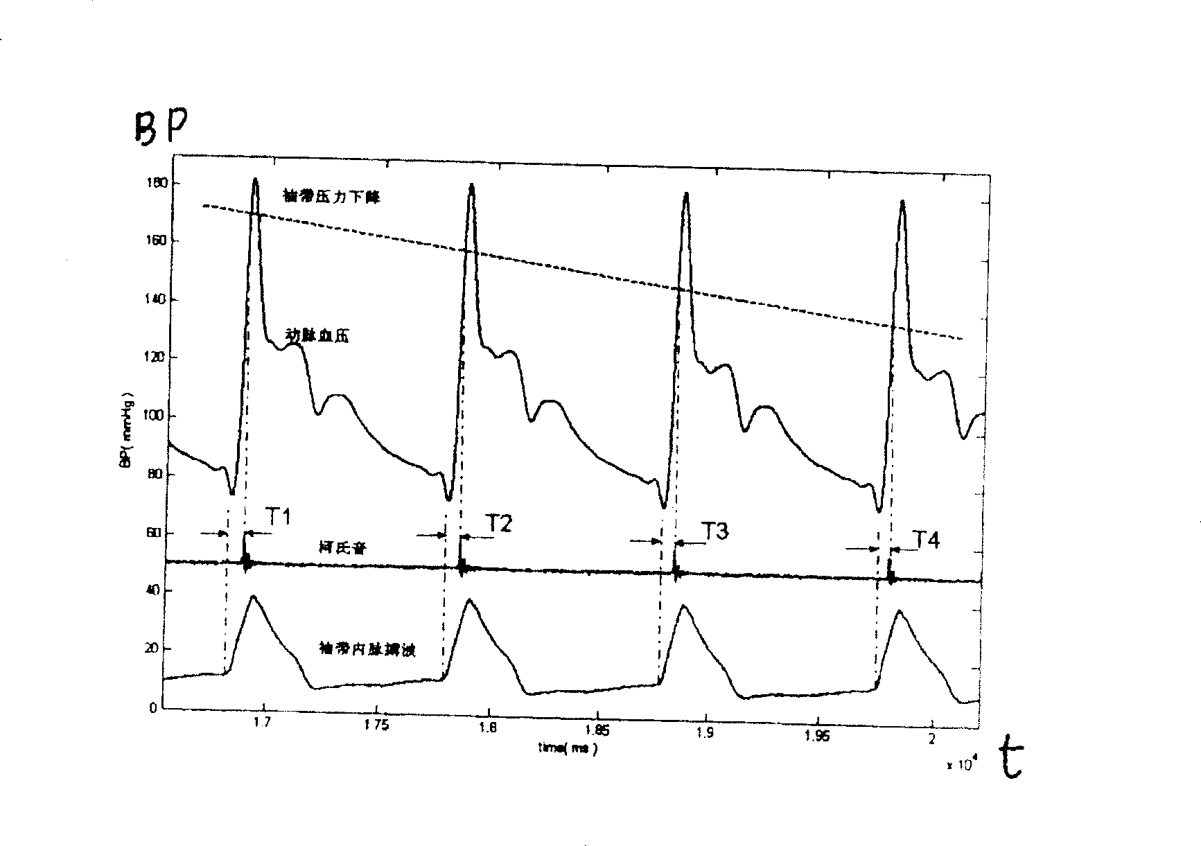 Detection method for blood pressure monitor with korotkoff sound delaying and pulse wave conducting time, and signal generator applying the same