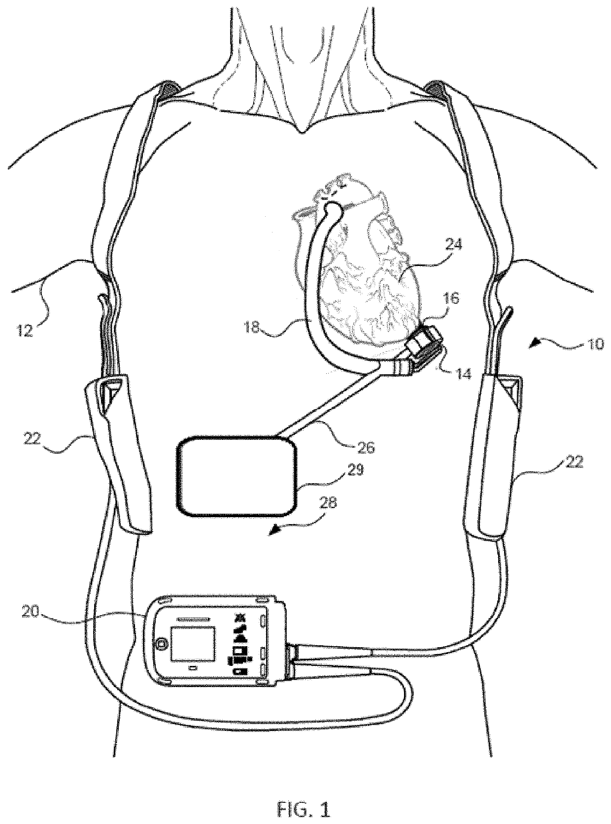 Mechanical gauge for estimating inductance changes in resonant power transfer systems with flexible coils for use with implanted medical devices