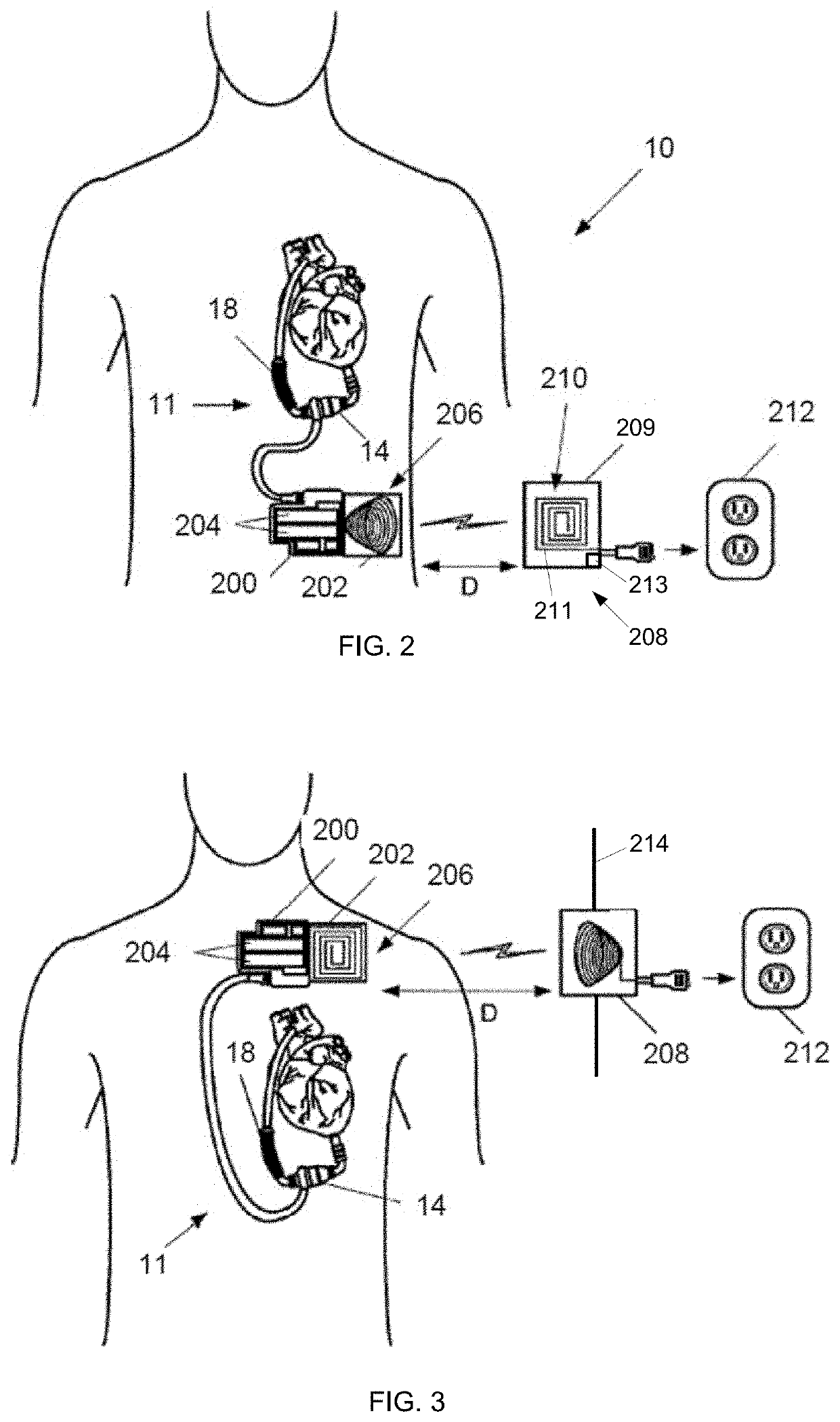 Mechanical gauge for estimating inductance changes in resonant power transfer systems with flexible coils for use with implanted medical devices