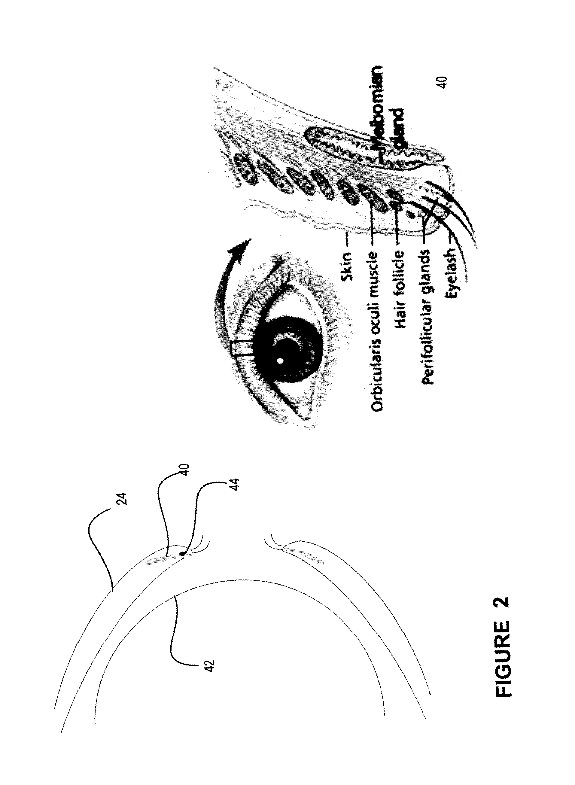 Method, system and use for therapeutic ultrasound