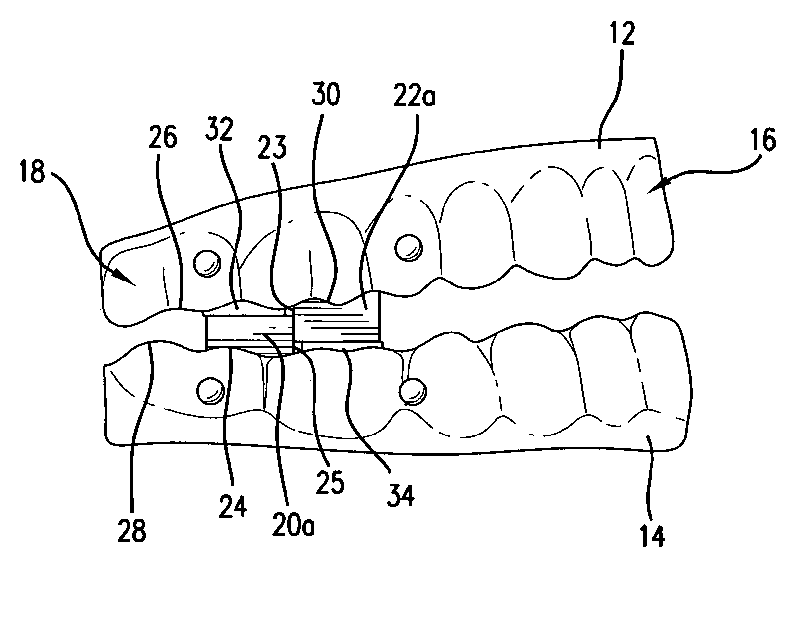 Dental appliance for the treatment of sleep disorders