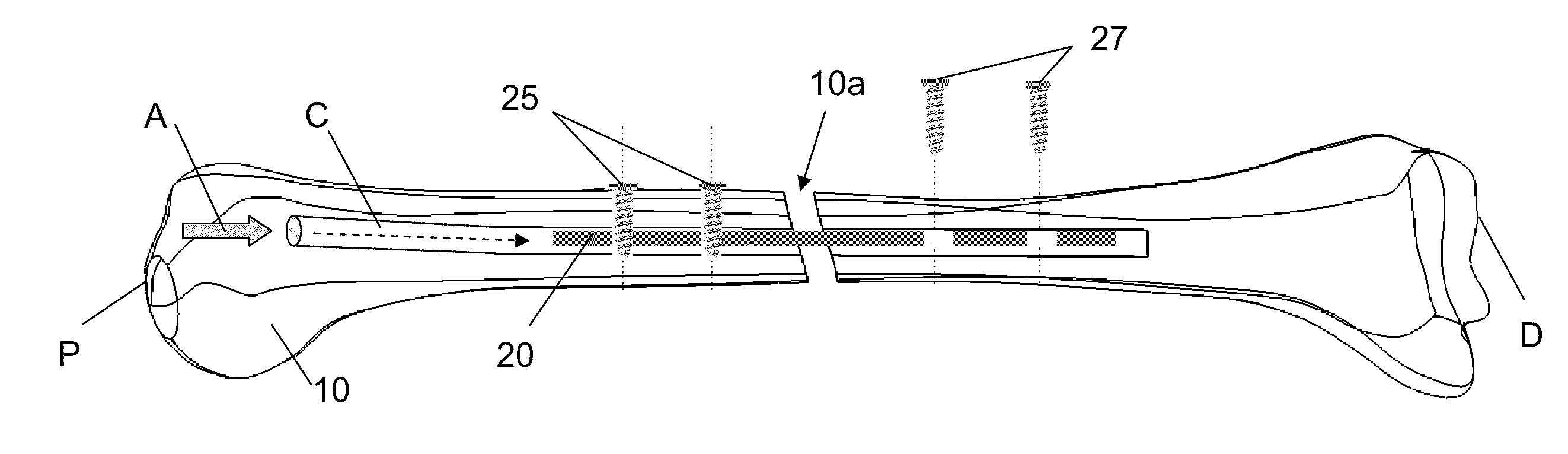 Endosteal nail plate for fixing bone segments