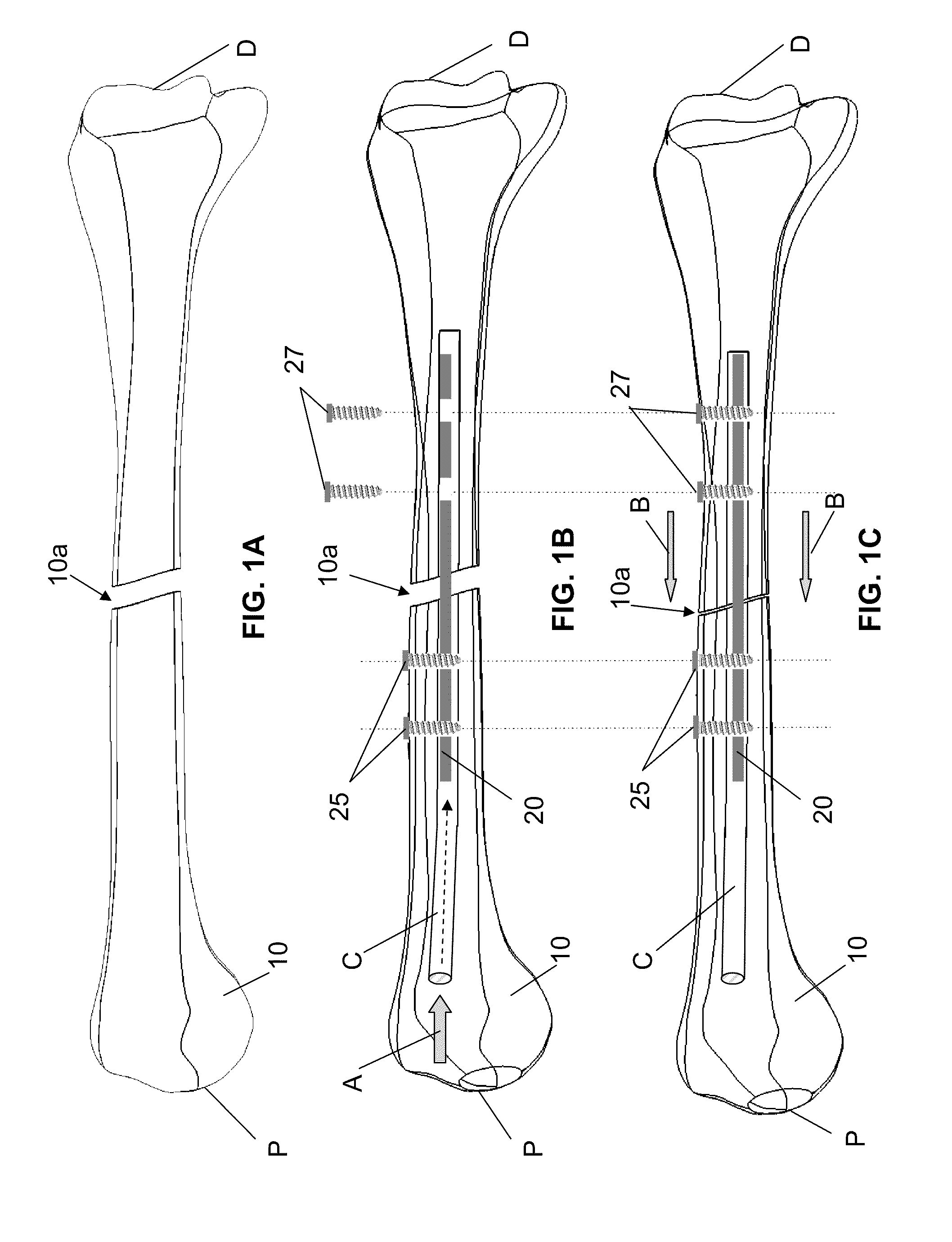 Endosteal nail plate for fixing bone segments