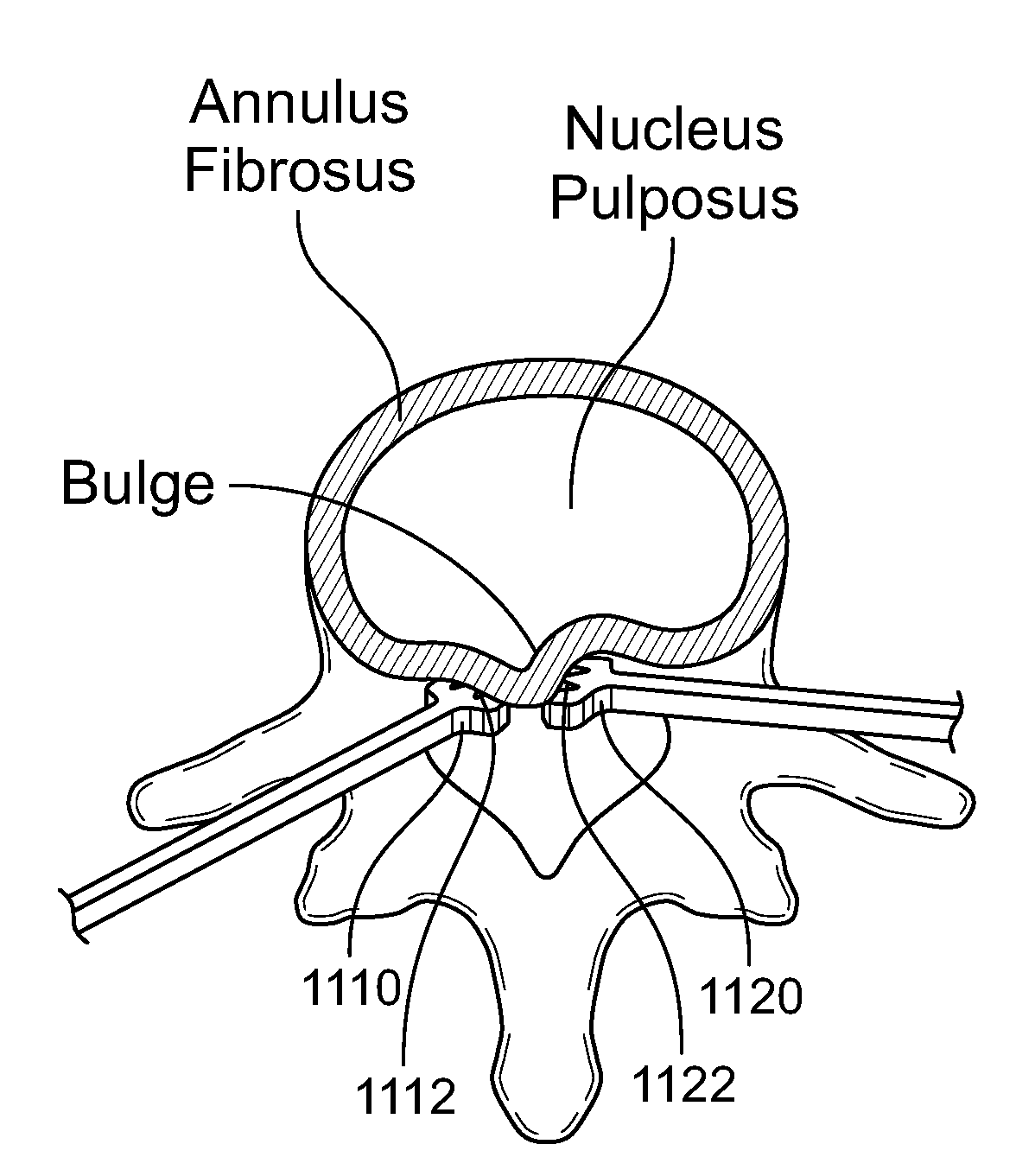 Treatment of spinal tissue