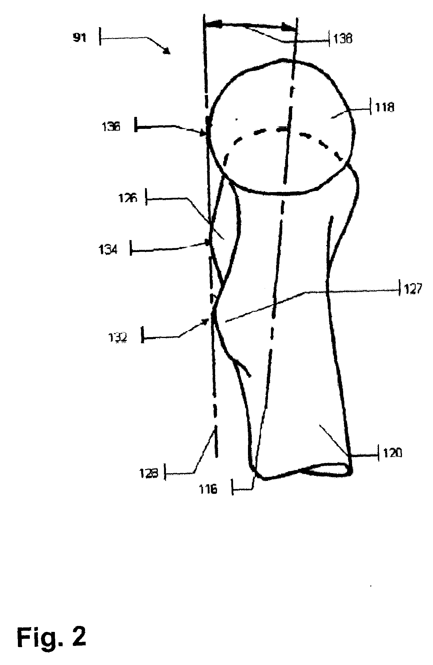 Method and Apparatus for Computer-Assisted Femoral Head Resurfacing