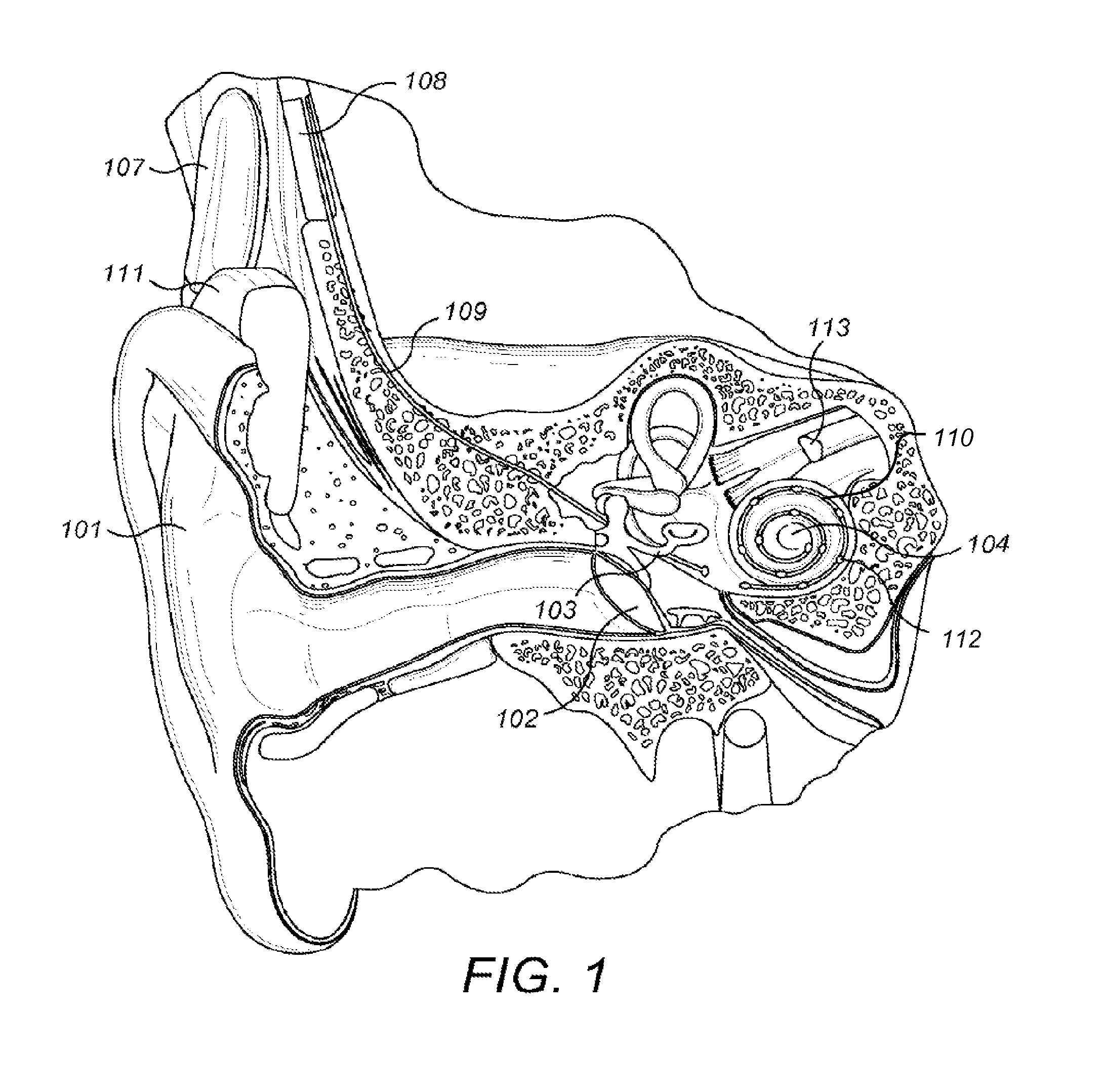 Objective Allocation of Implant Electrode Bands Based on Excitation Spread