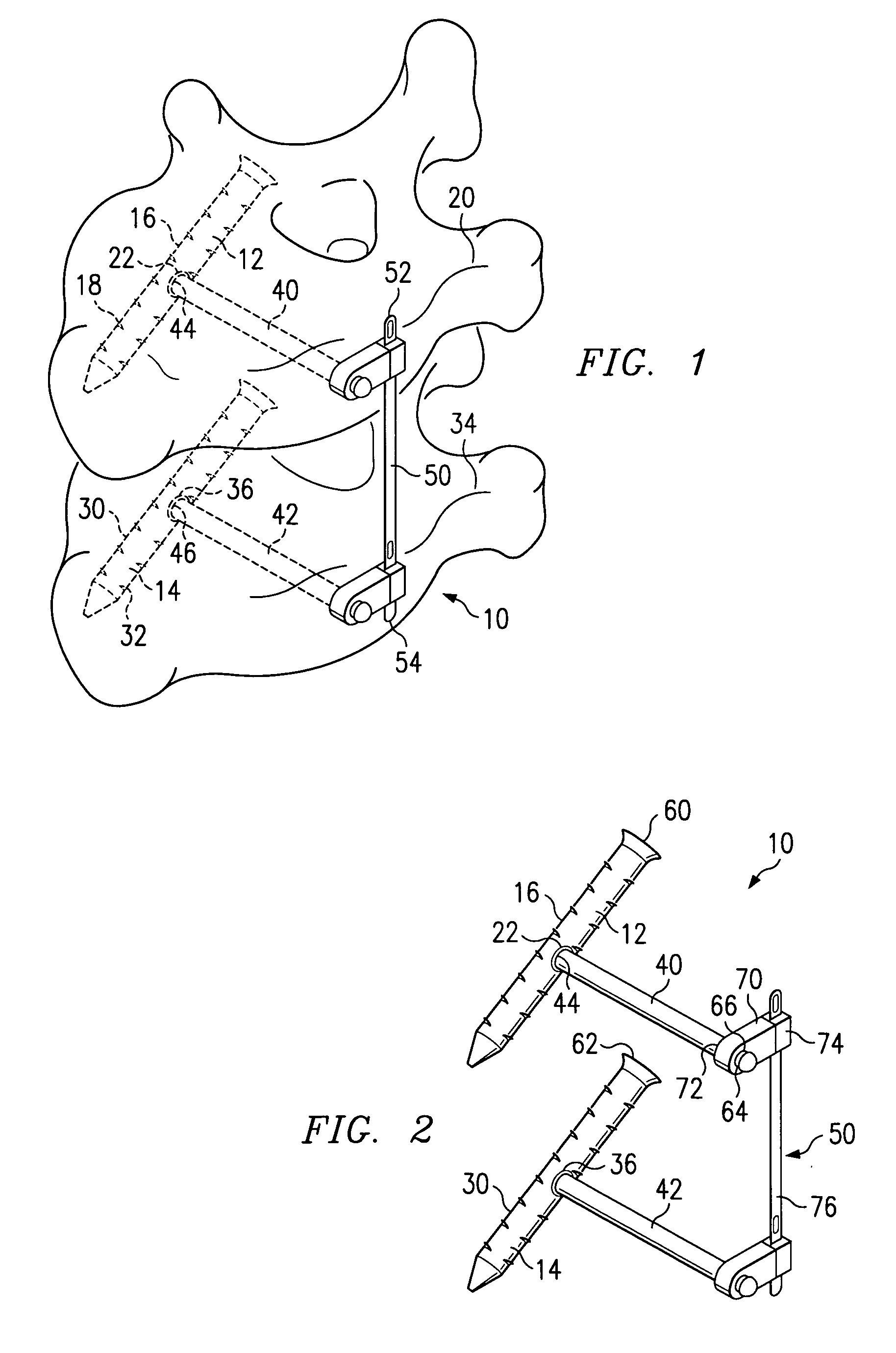 Vertebral stabilization assembly and method