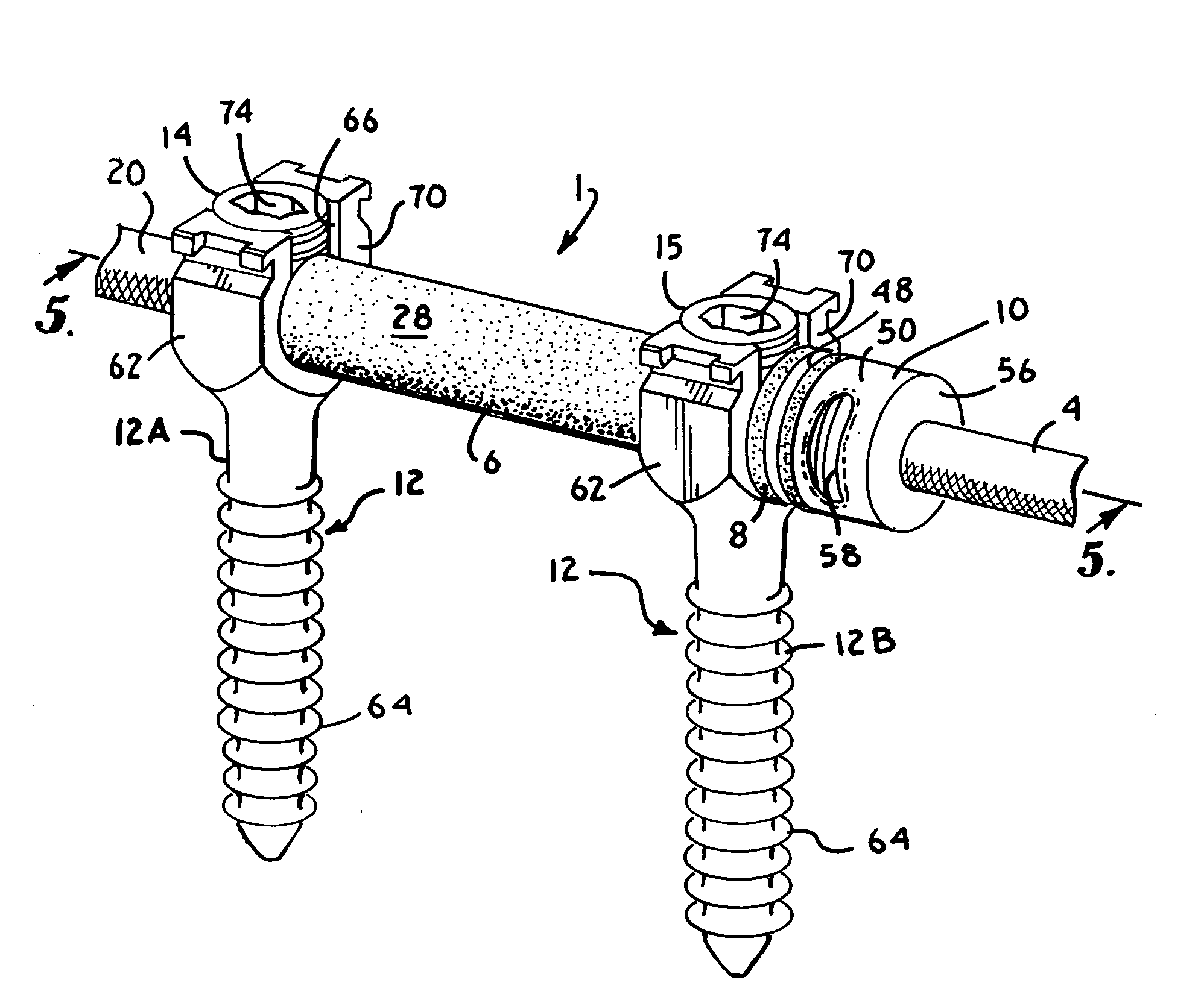 Dynamic spinal stabilization assembly with elastic bumpers and locking limited travel closure mechanisms