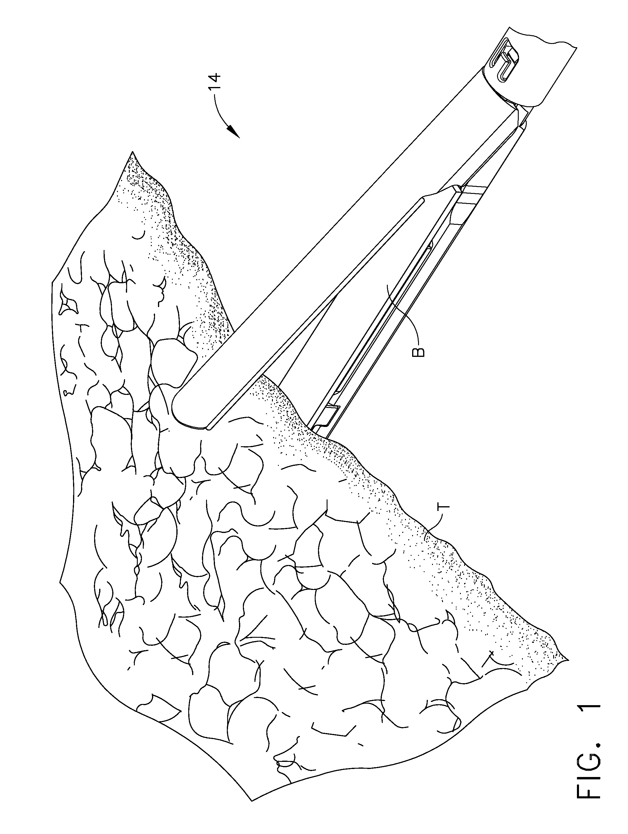 Buttress material having an activatable adhesive