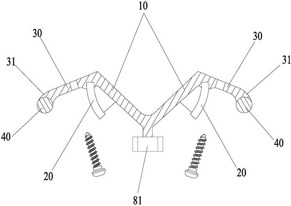 Spine fixing assembly