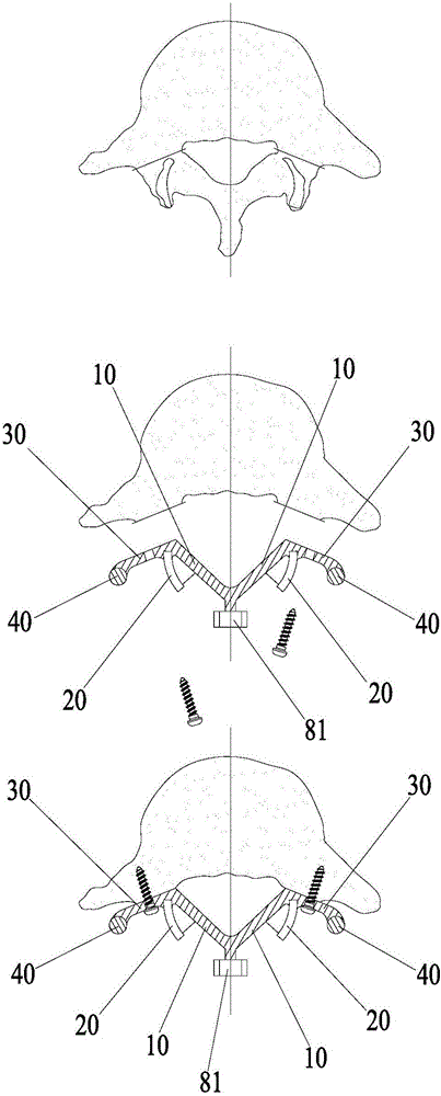 Spine fixing assembly