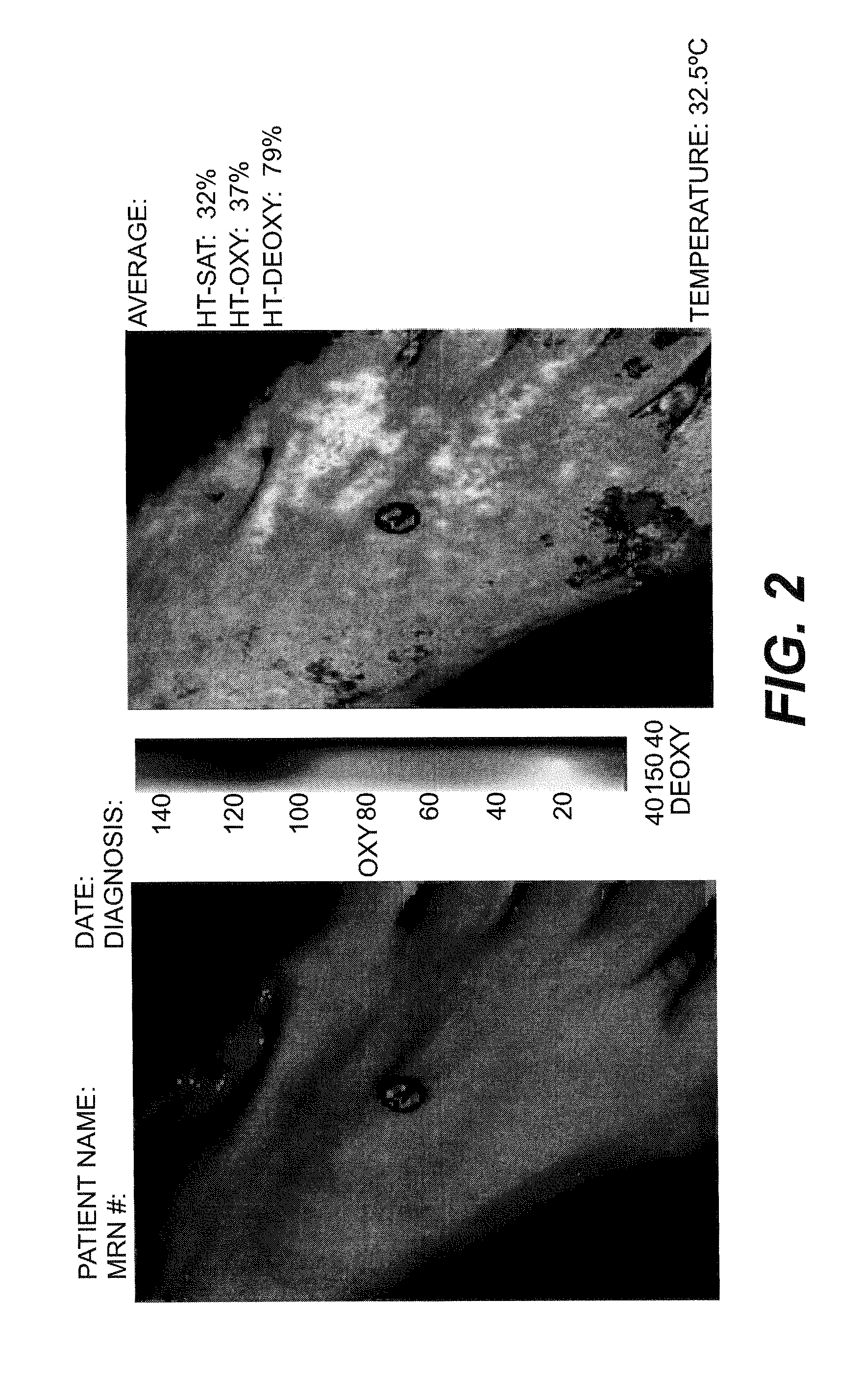 OxyVu-1 hyperspectral tissue oxygenation (HTO) measurement system