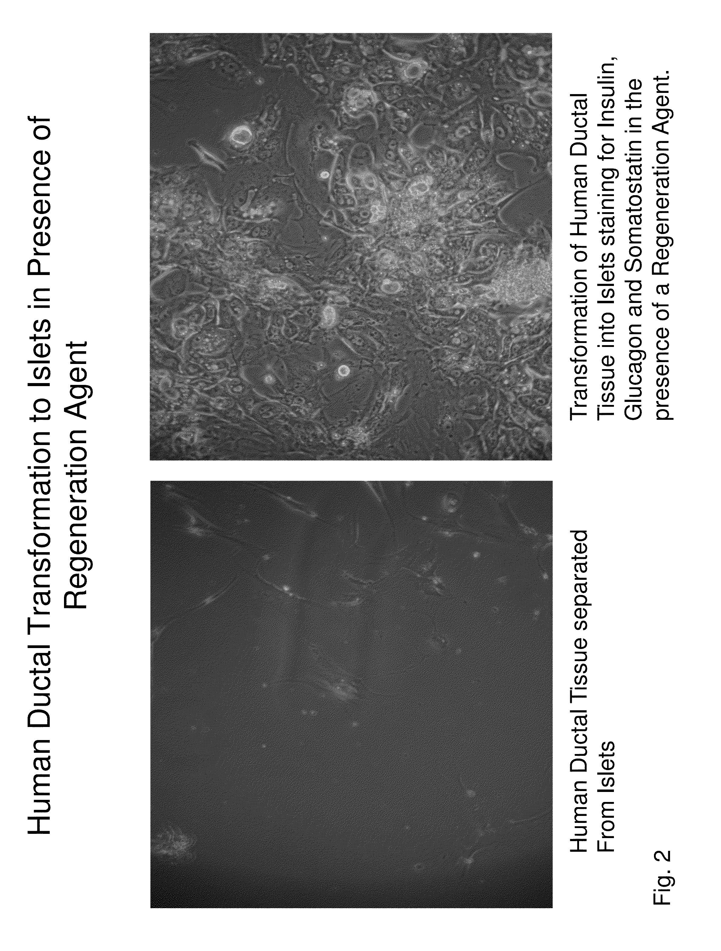 Insulin independence among patients with diabetes utilizing a ppi in combination with an immune tolerance agent