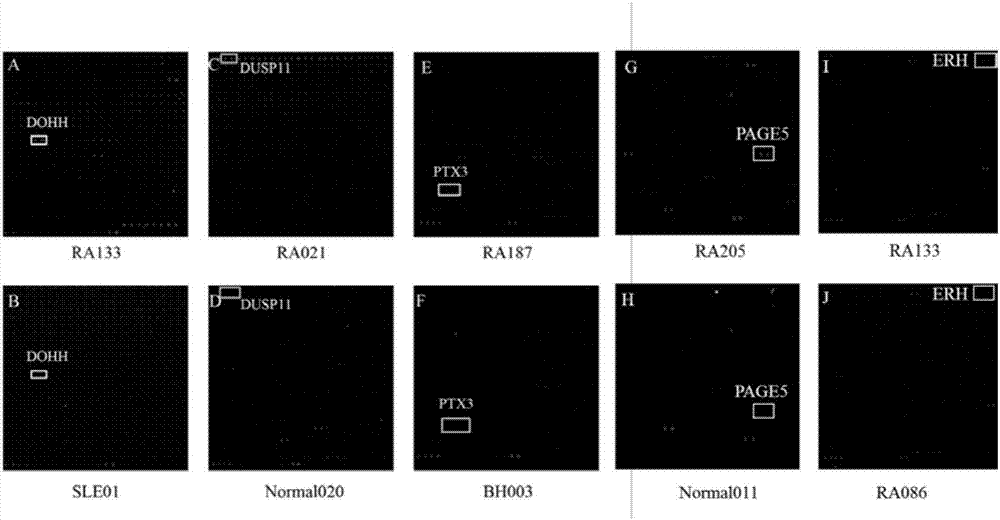 Diagnosis marker for ACPA-negative RA and application thereof