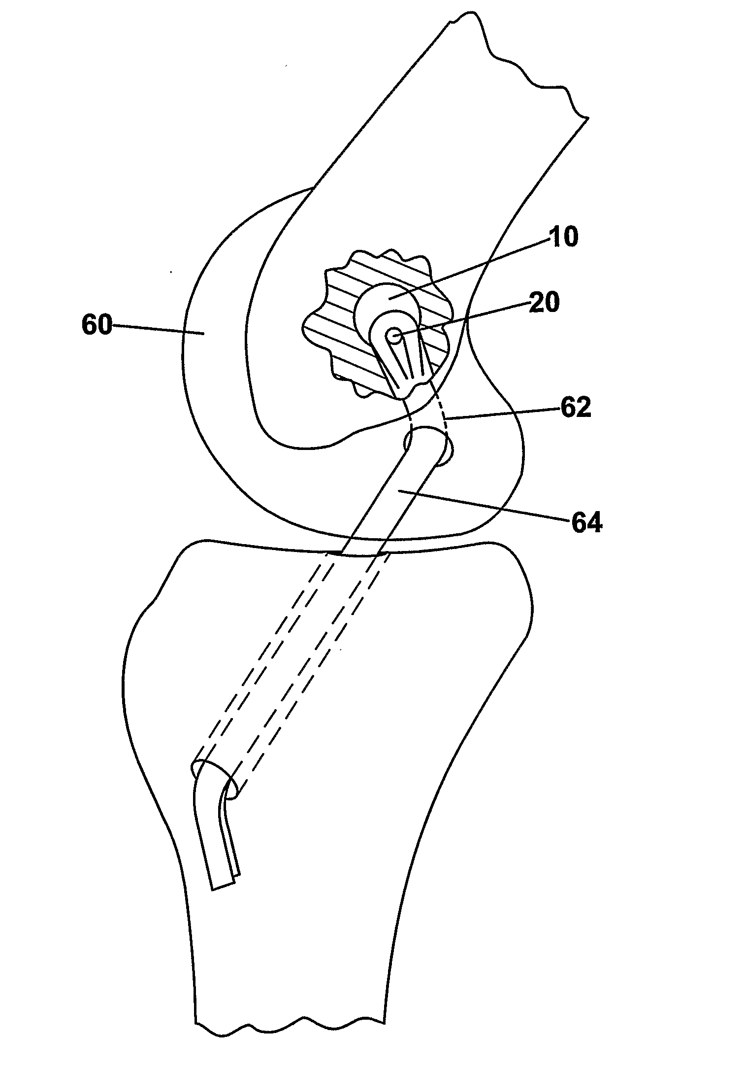 Adjustable ligament graft fixation