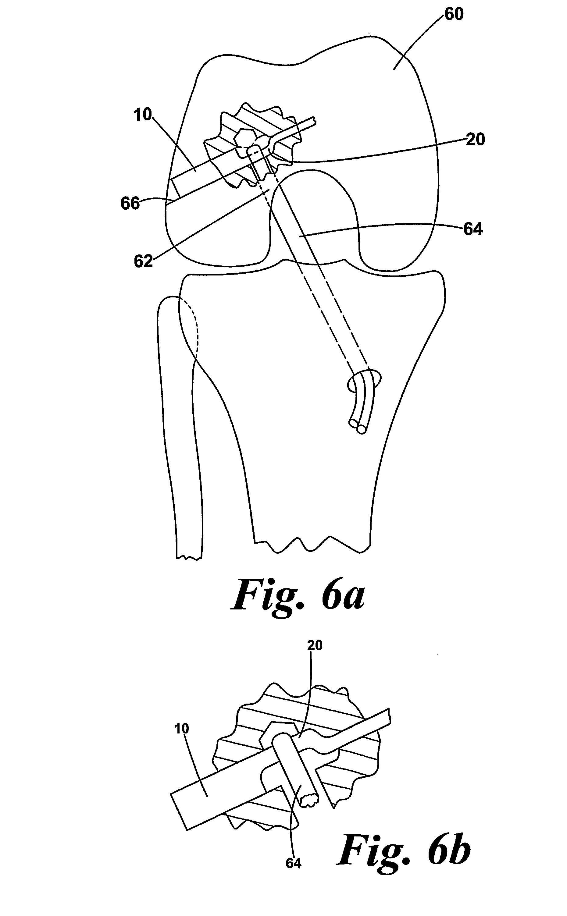 Adjustable ligament graft fixation