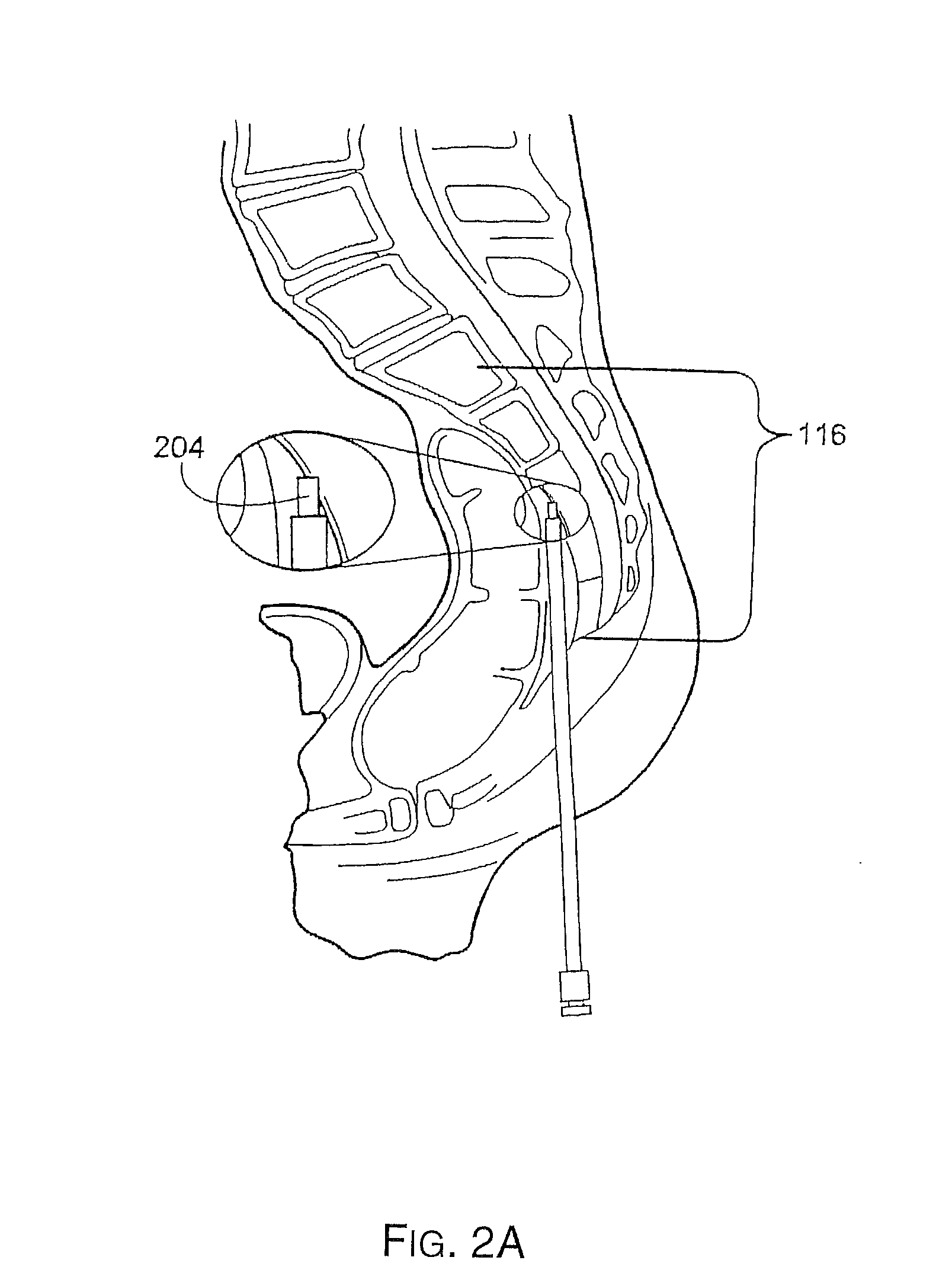 Preformed membranes for use in intervertebral disc spaces