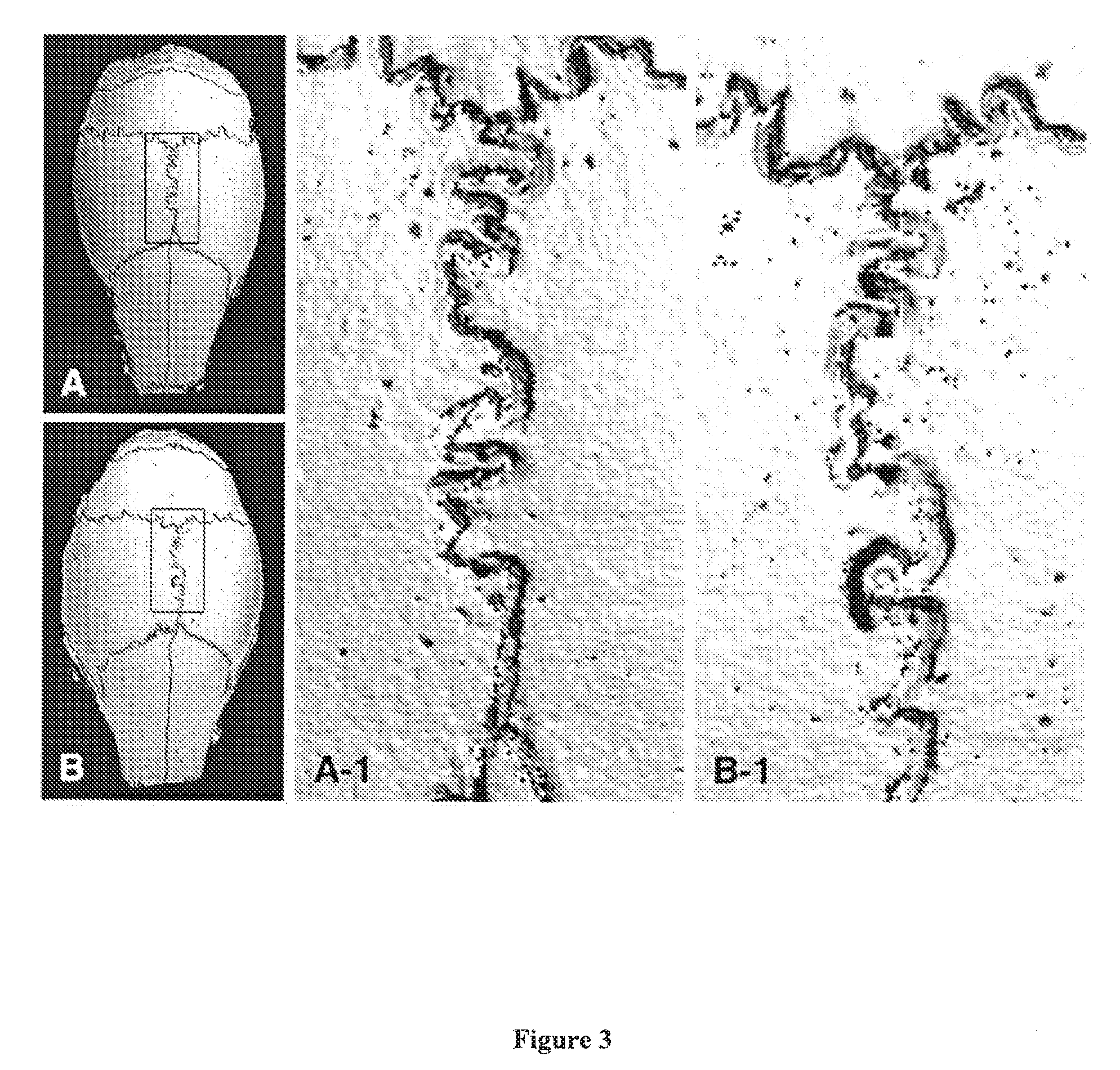 Compositions and Methods for Detecting and Treating Implant Loosening and Osteolysis