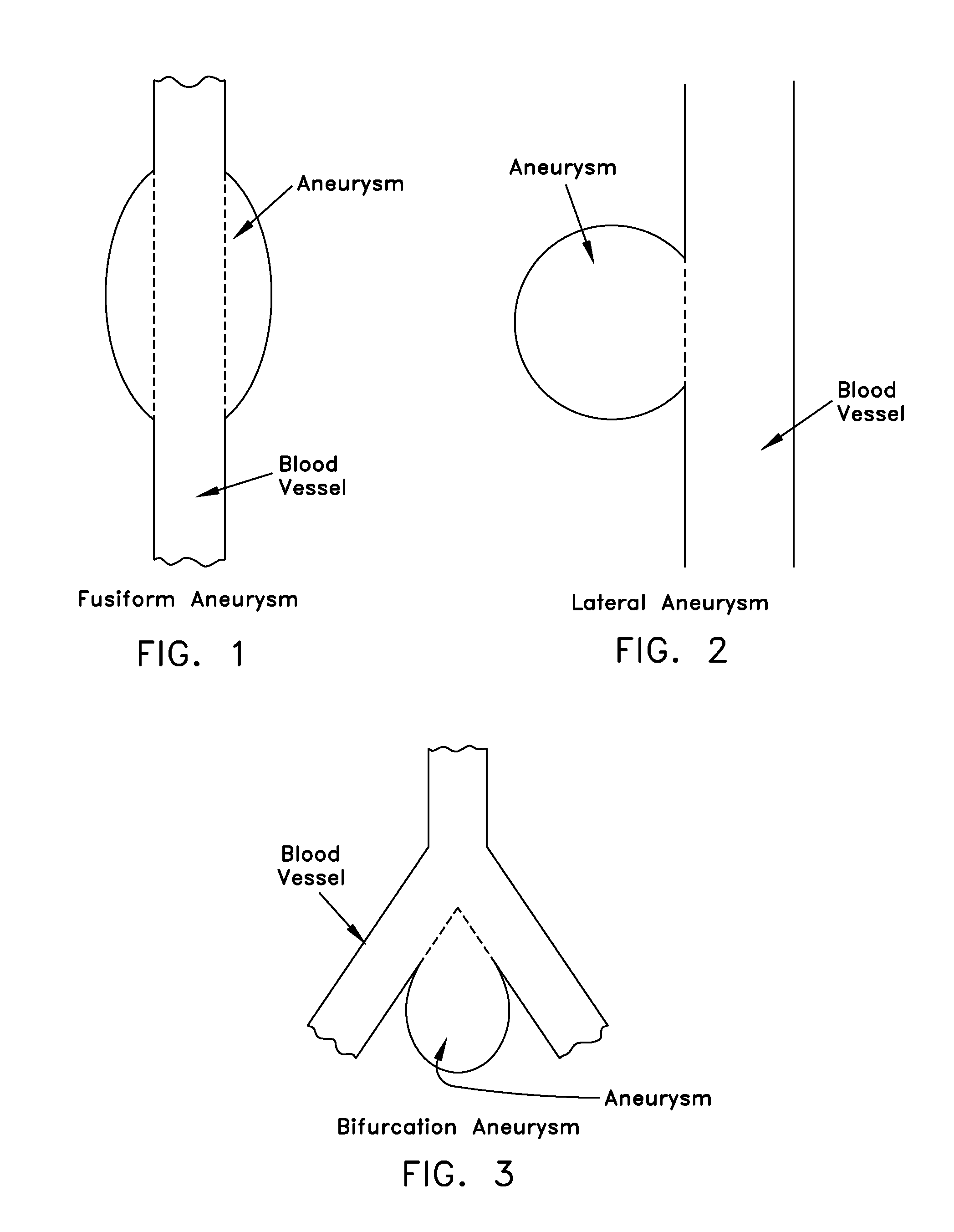 Method and apparatus for restricting flow through an opening in the side wall