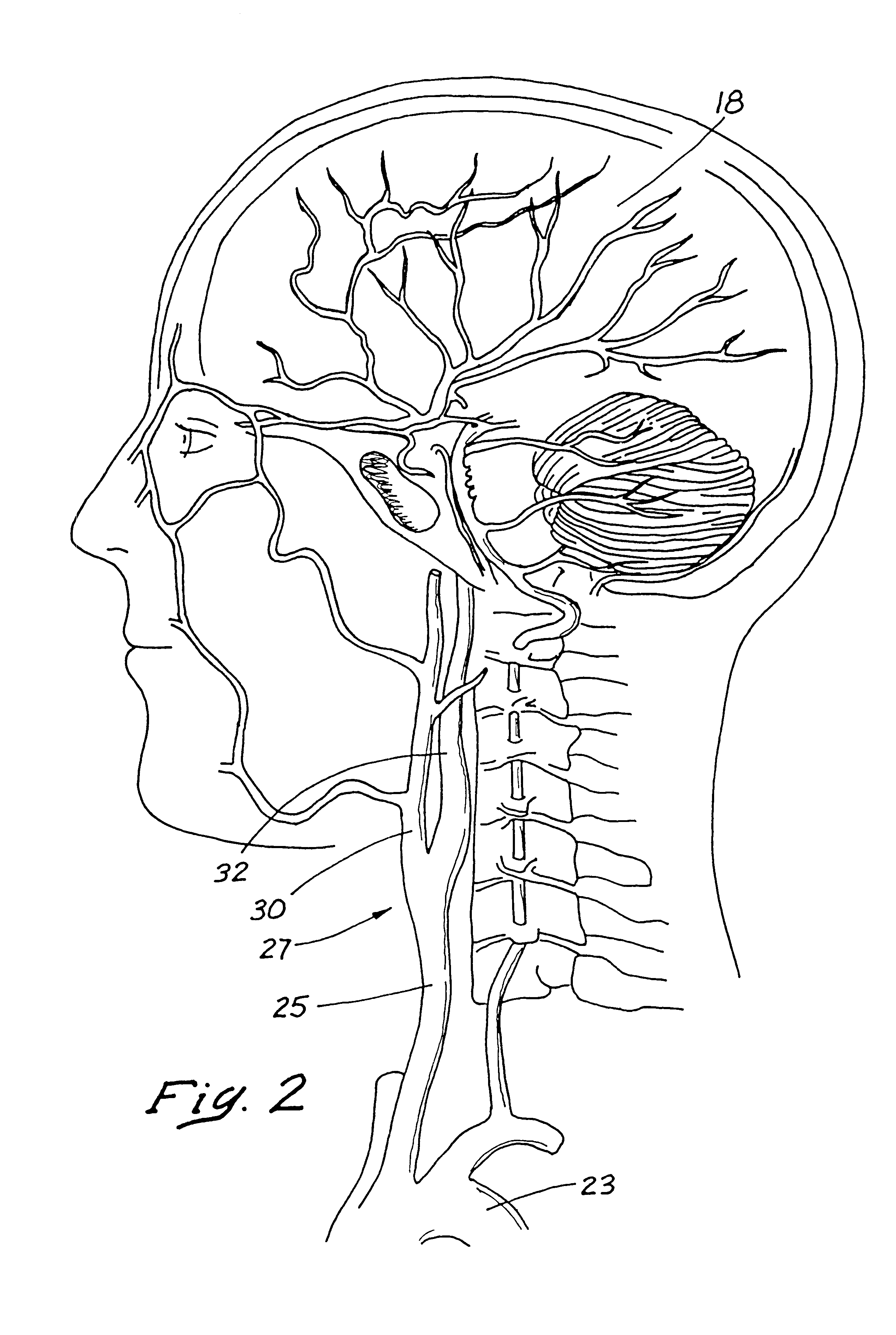 Indwelling heat exchange catheter and method of using same