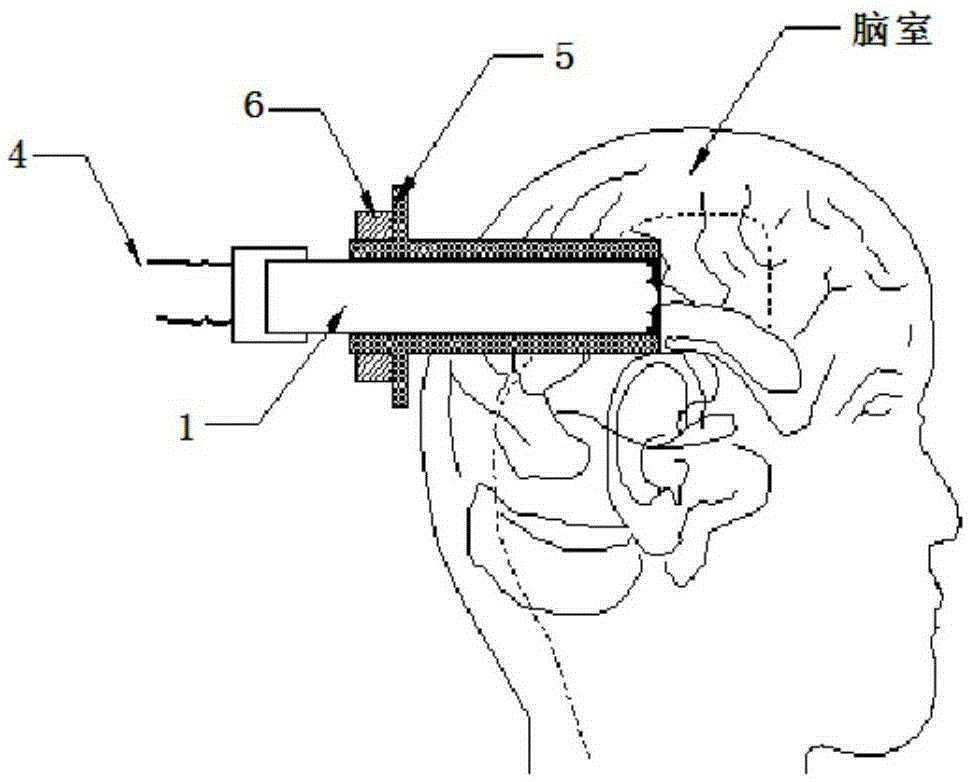 A Visual Ventricle and Subdural Epidural Drainage System