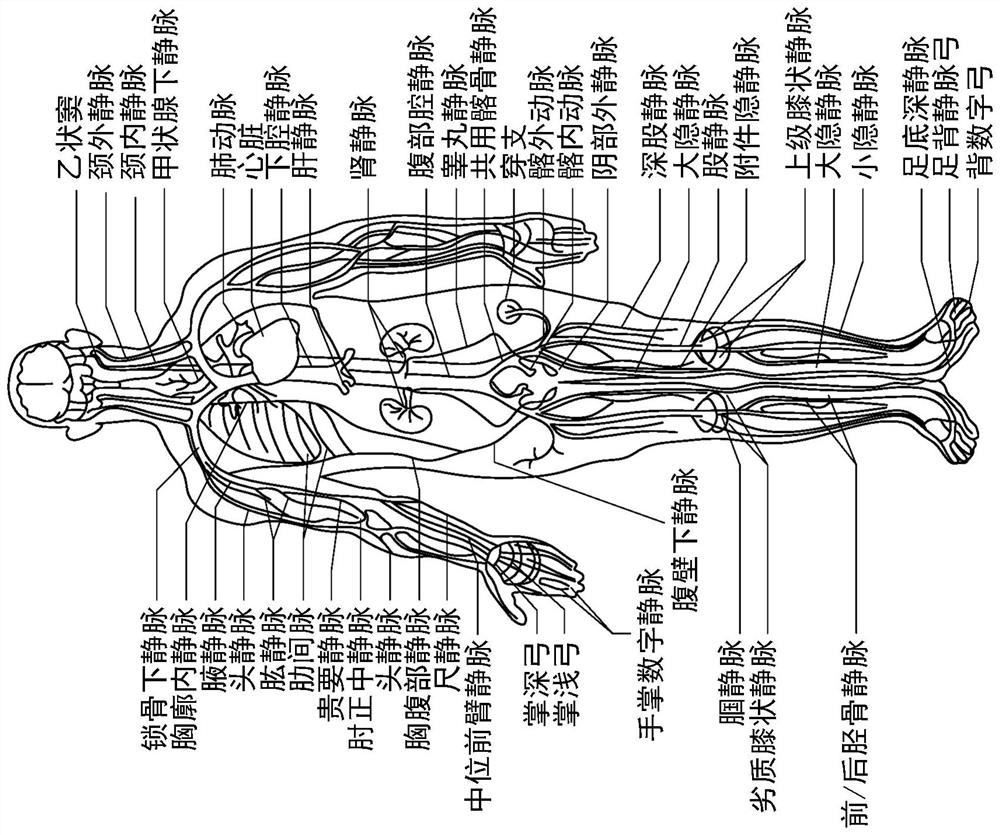 Graphical longitudinal display for intraluminal ultrasound imaging and associated devices, systems, and methods