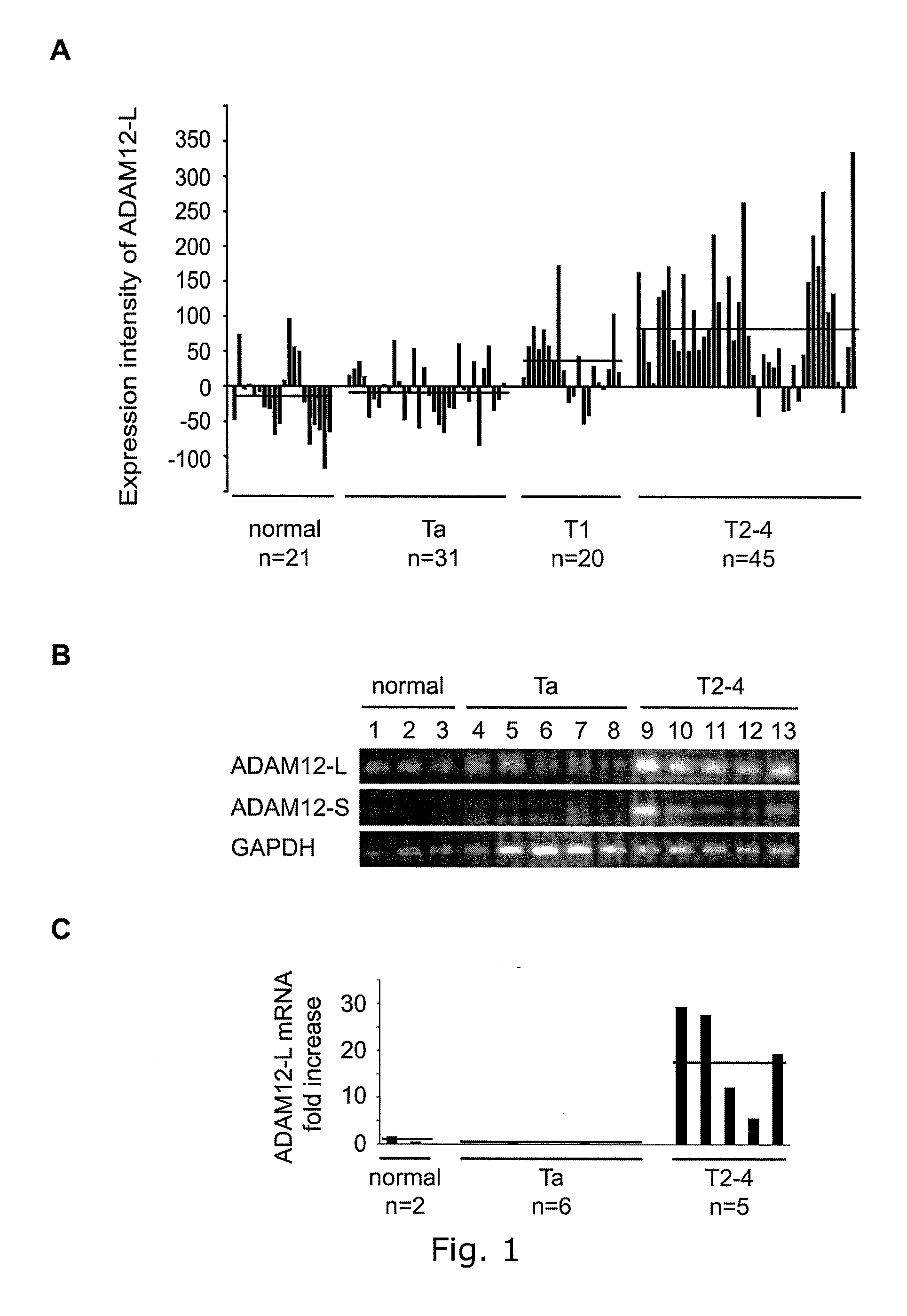 Adam12 as a biomarker for bladder cancer