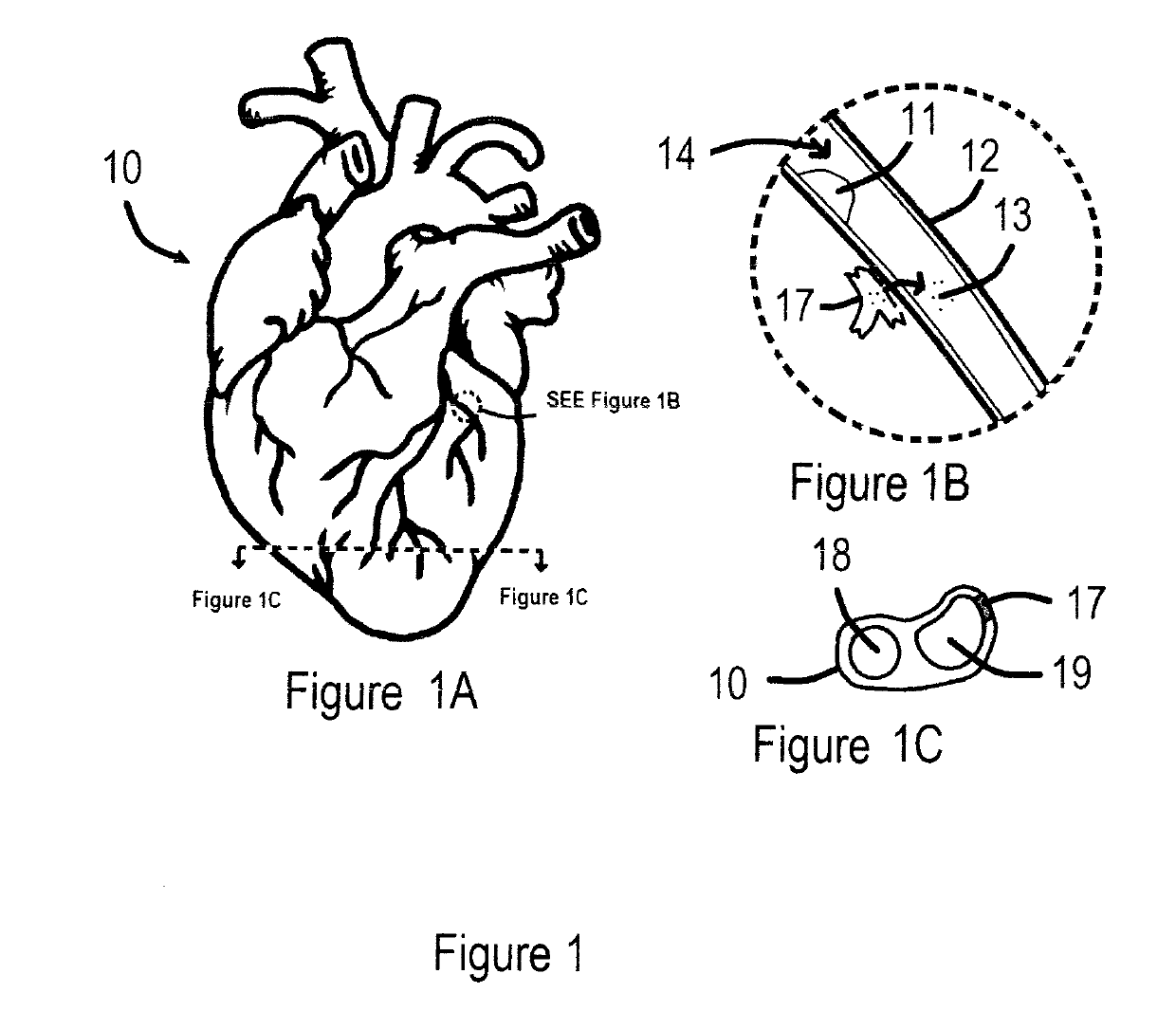 ASSISTED CAPACITY DEVICE CALCULATOR FOR MYOCARDIAL INFARCTION (AC/DC for MI)